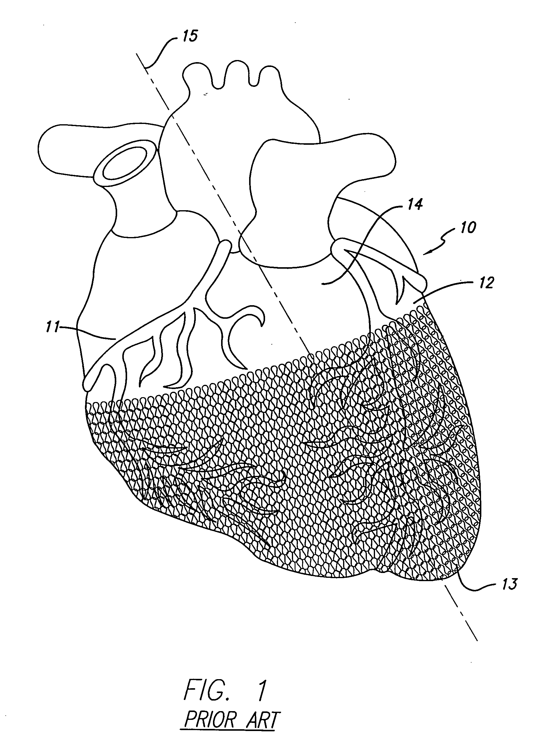 Cardiac harness for treating congestive heart failure and for defibrillating and/or pacing/sensing