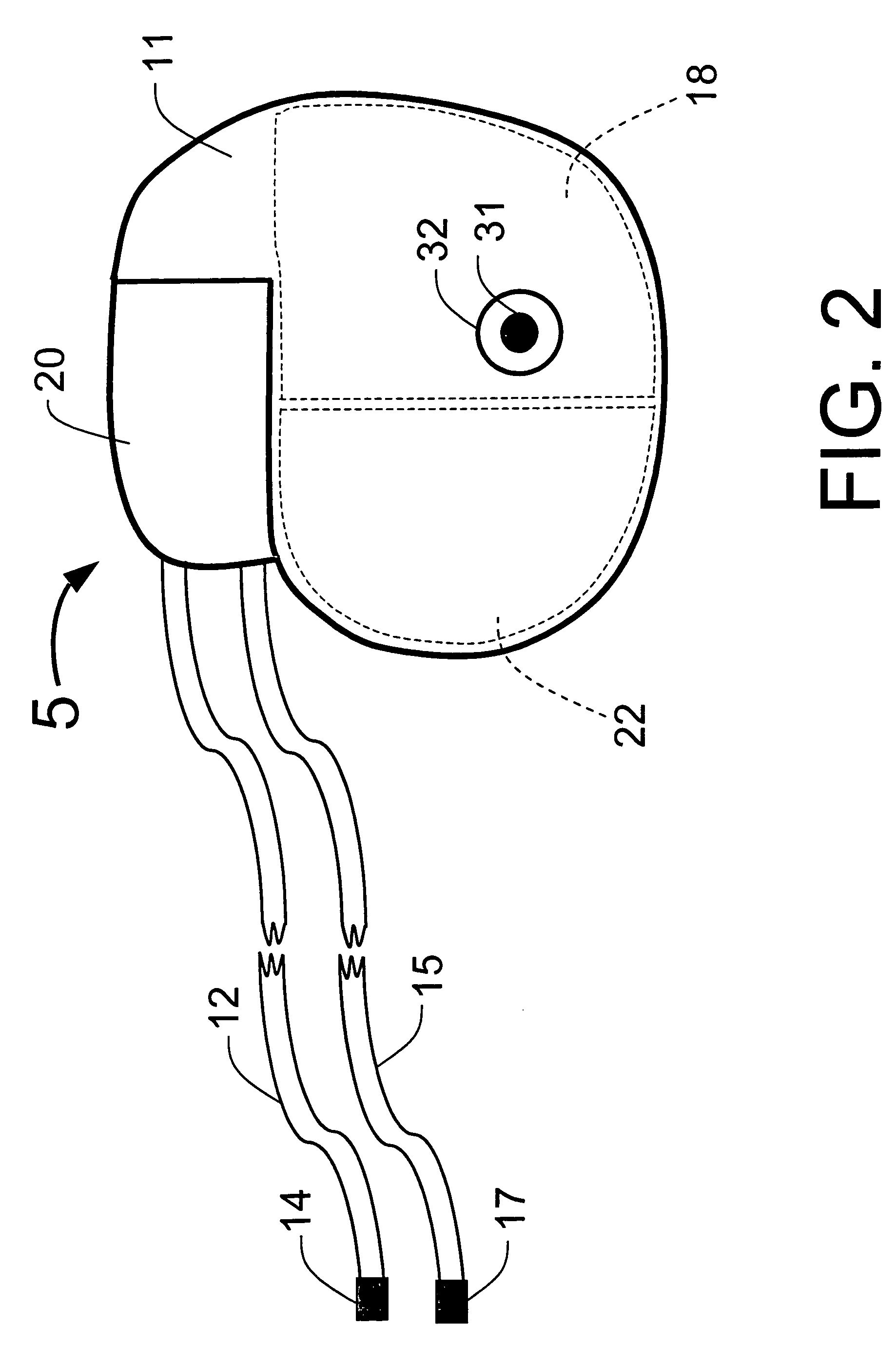 Implantable system for monitoring the condition of the heart