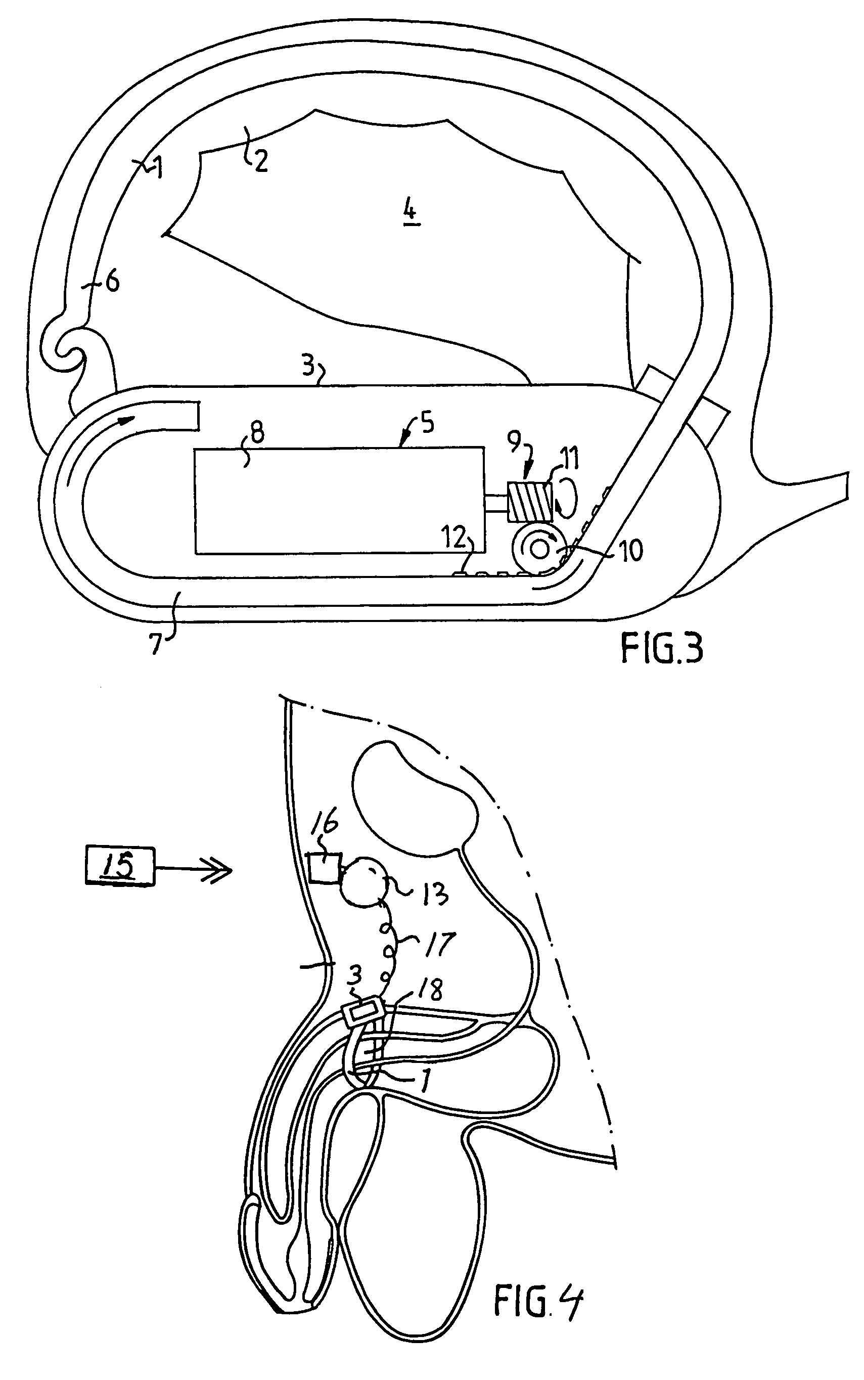 Careful impotence treatment apparatus