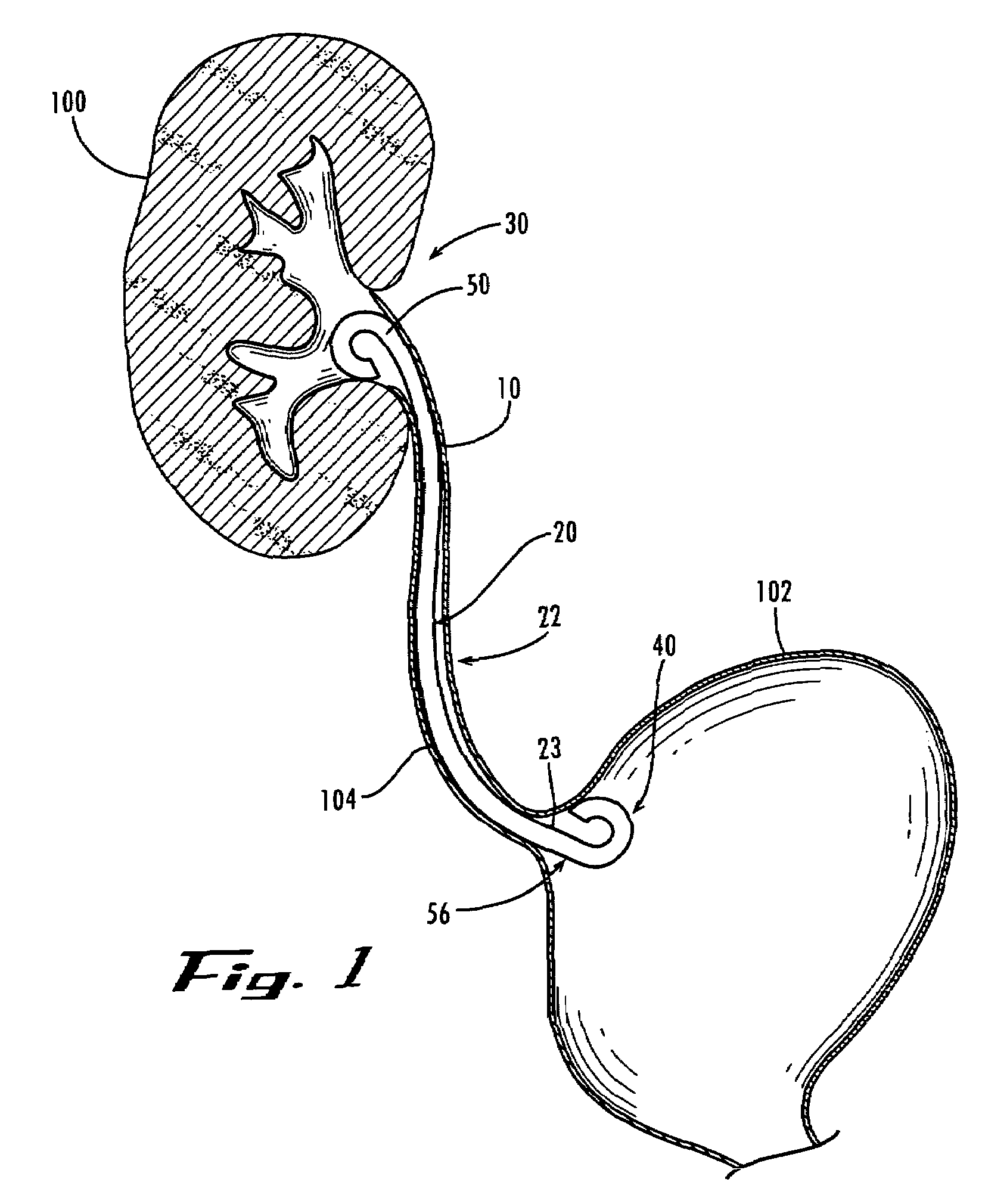 Stent with flexible elements