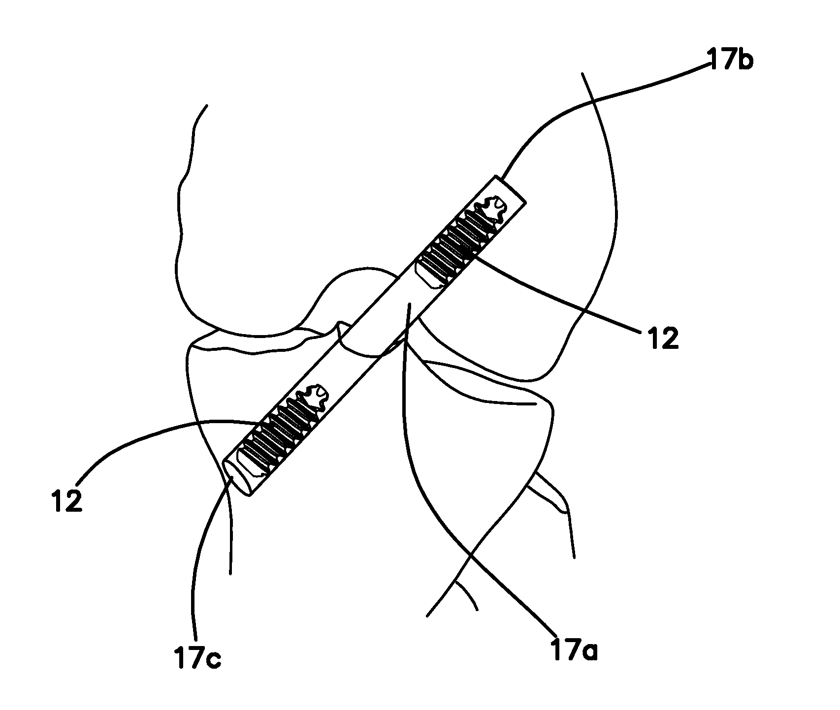 Self-tapping biocompatible interference bone screw