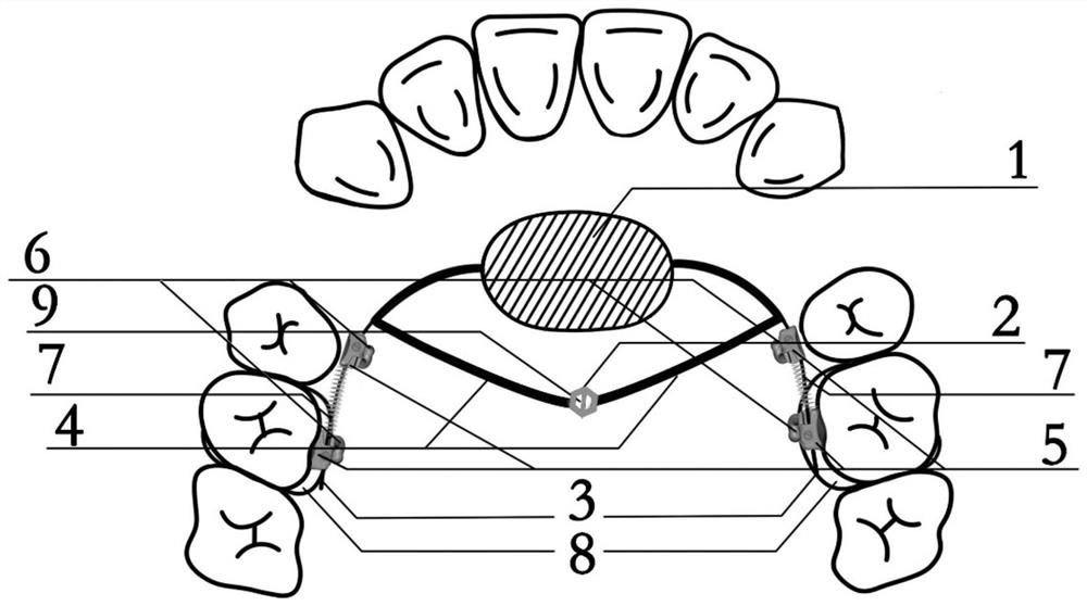 Nanoce arch orthodontic molar control device