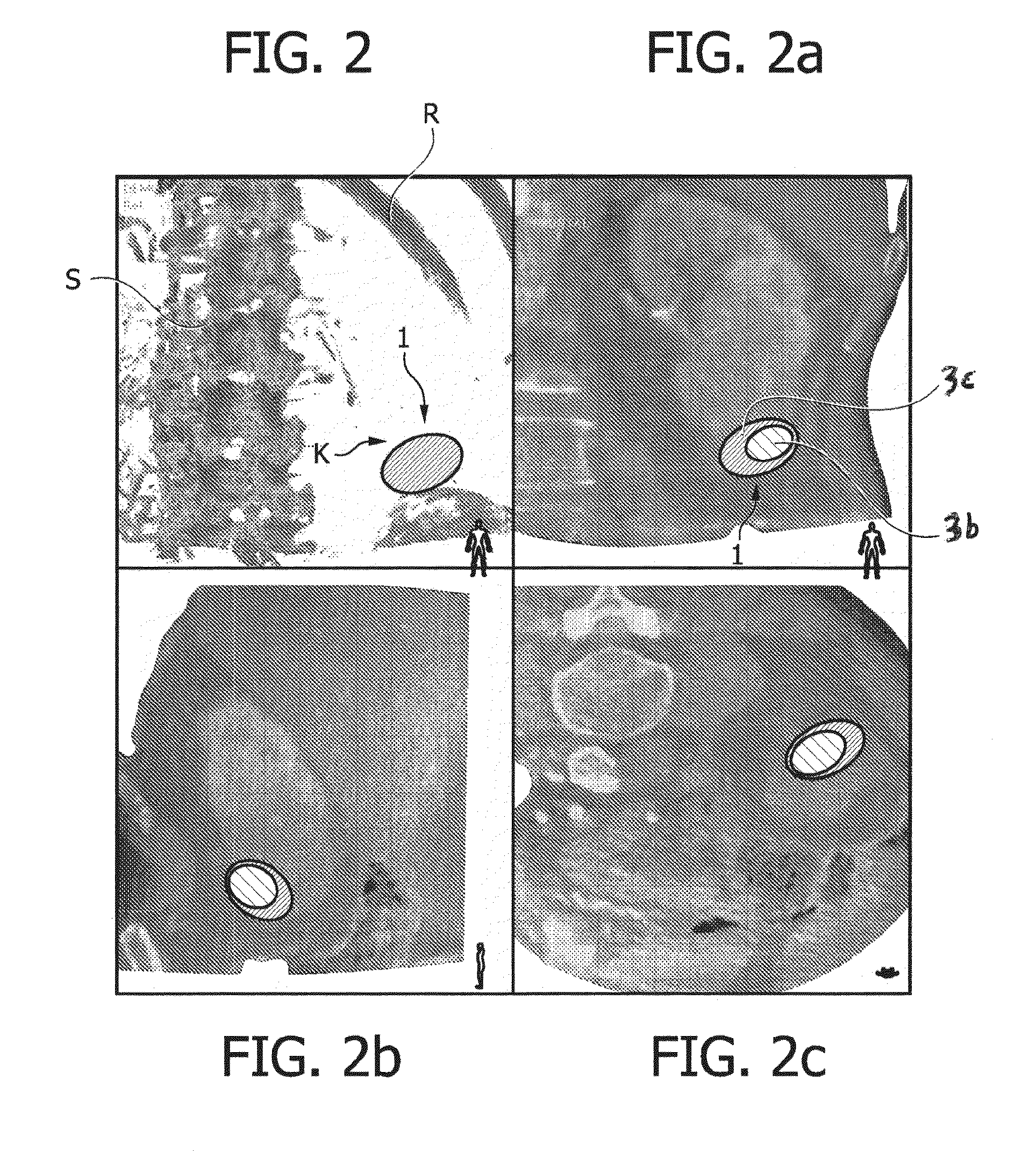 Clipping-plane-based ablation treatment planning