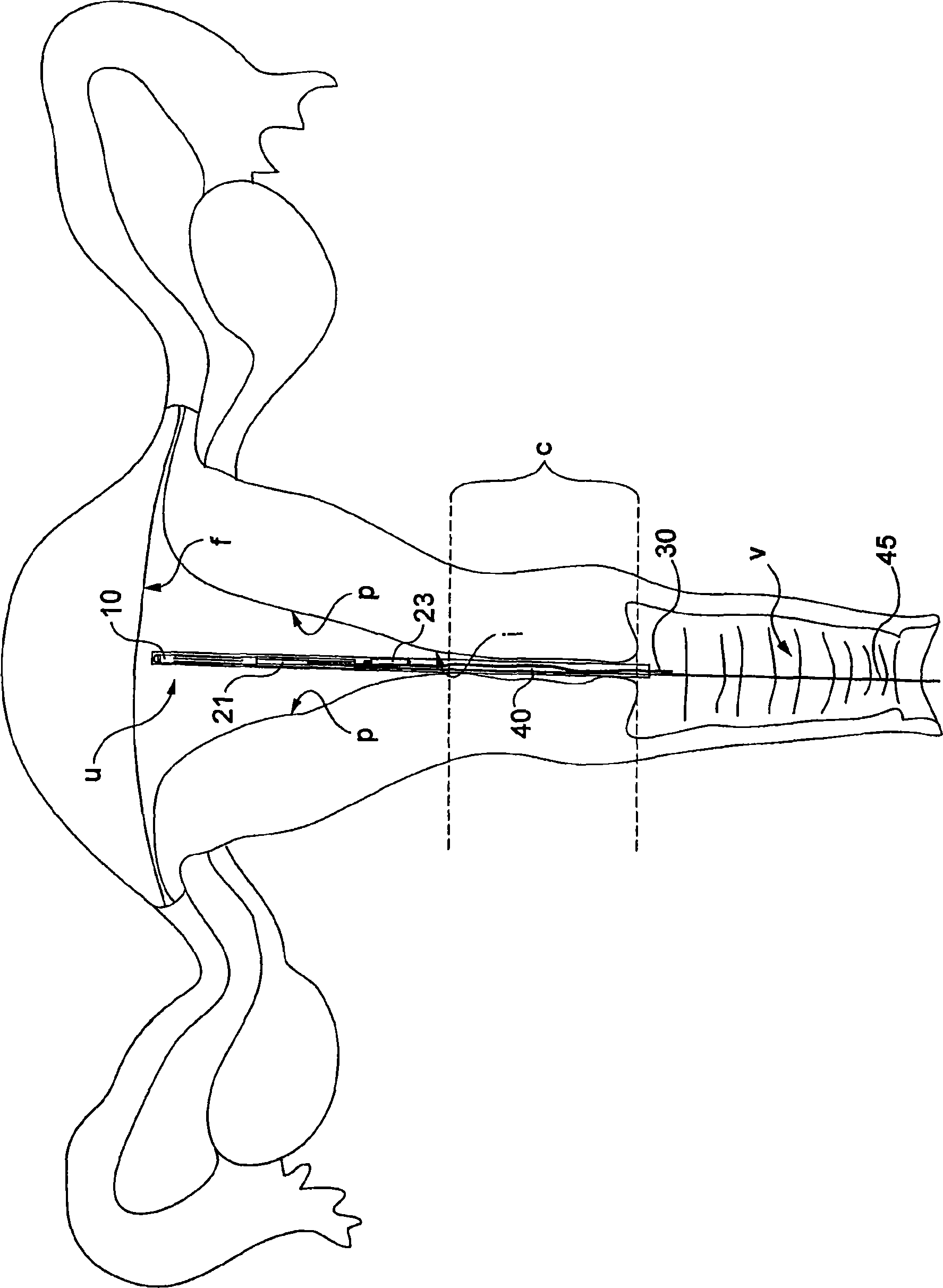 Recoverable intra-uterine system