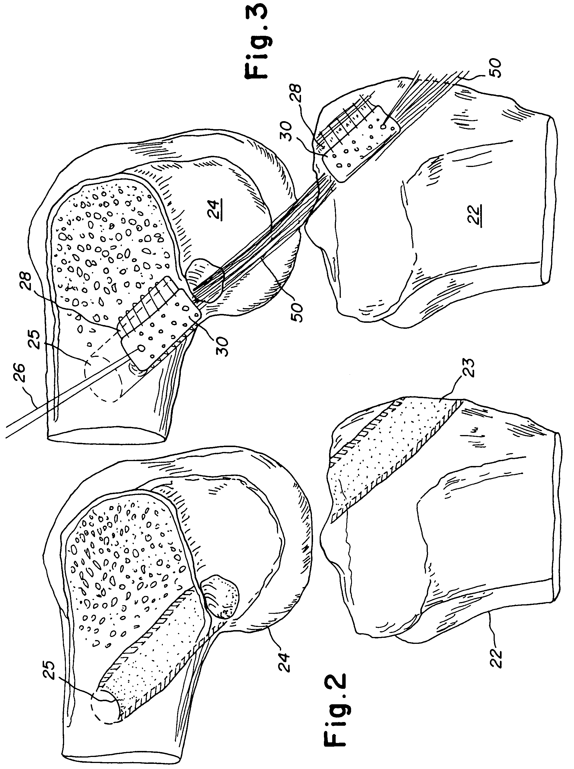 Bone-tendon- bone assembly with cancellous allograft bone block