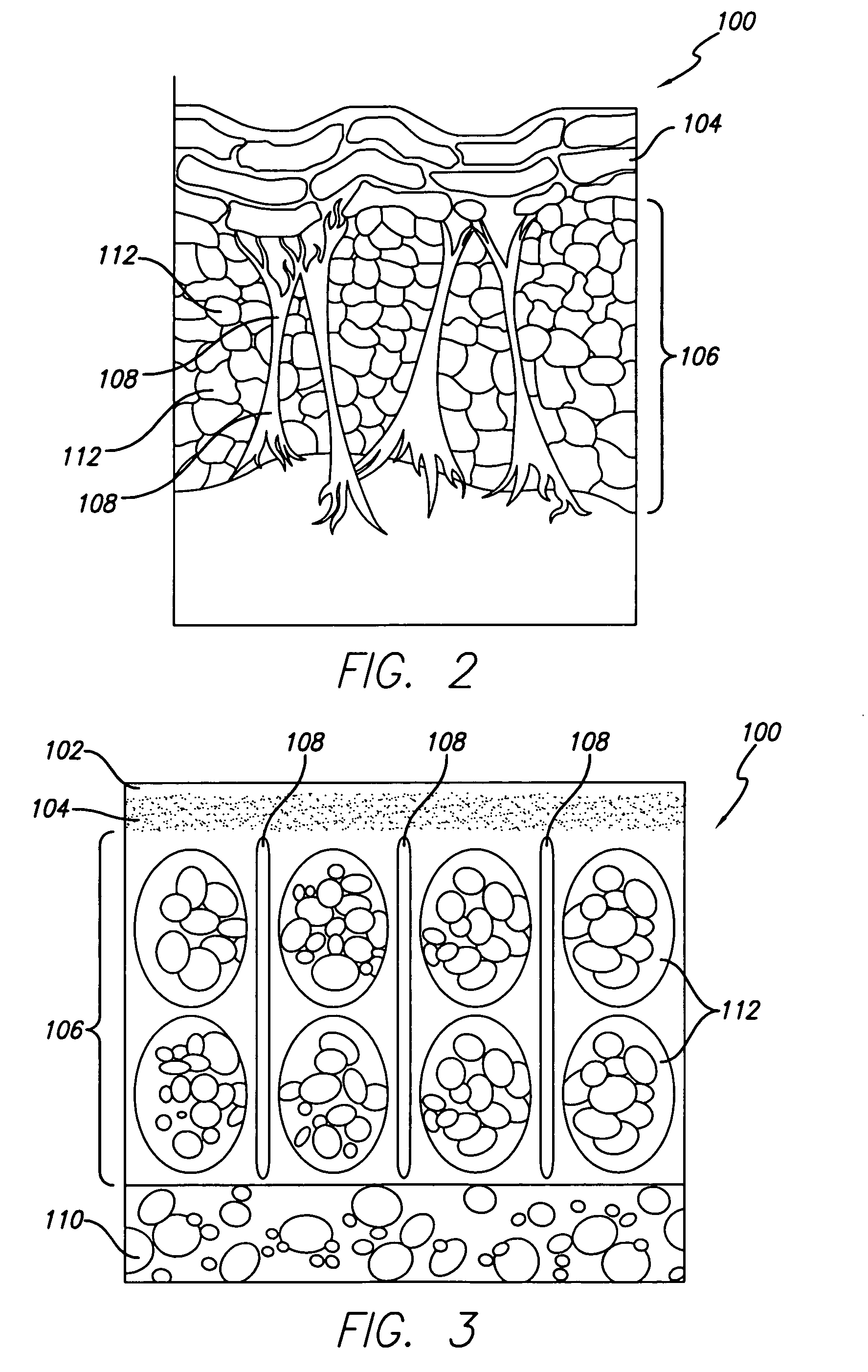 Method for treating subcutaneous tissues