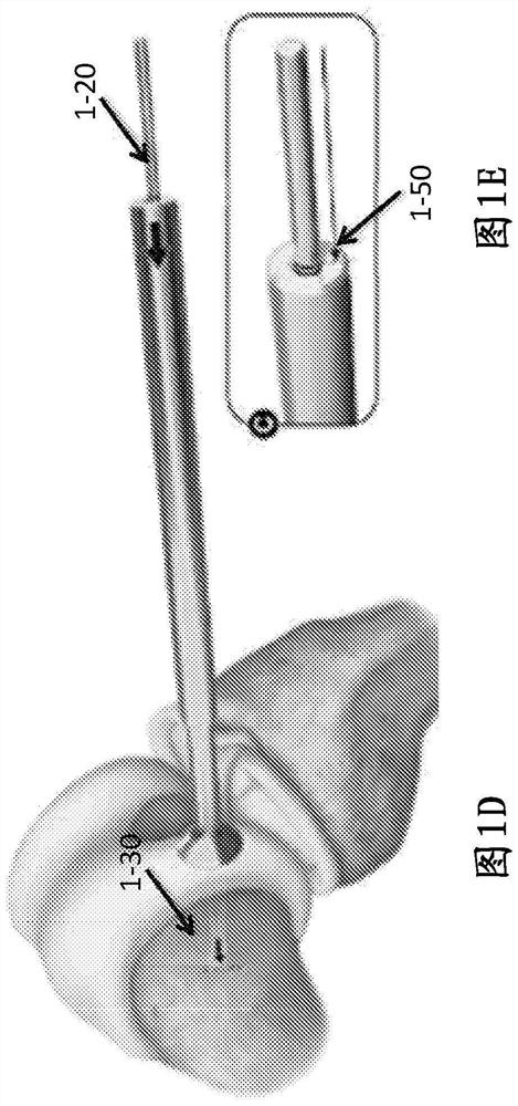 Implantation tool and protocol for optimized solid substrates promoting cell and tissue growth