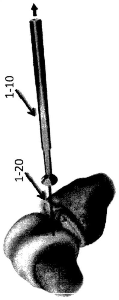 Implantation tool and protocol for optimized solid substrates promoting cell and tissue growth