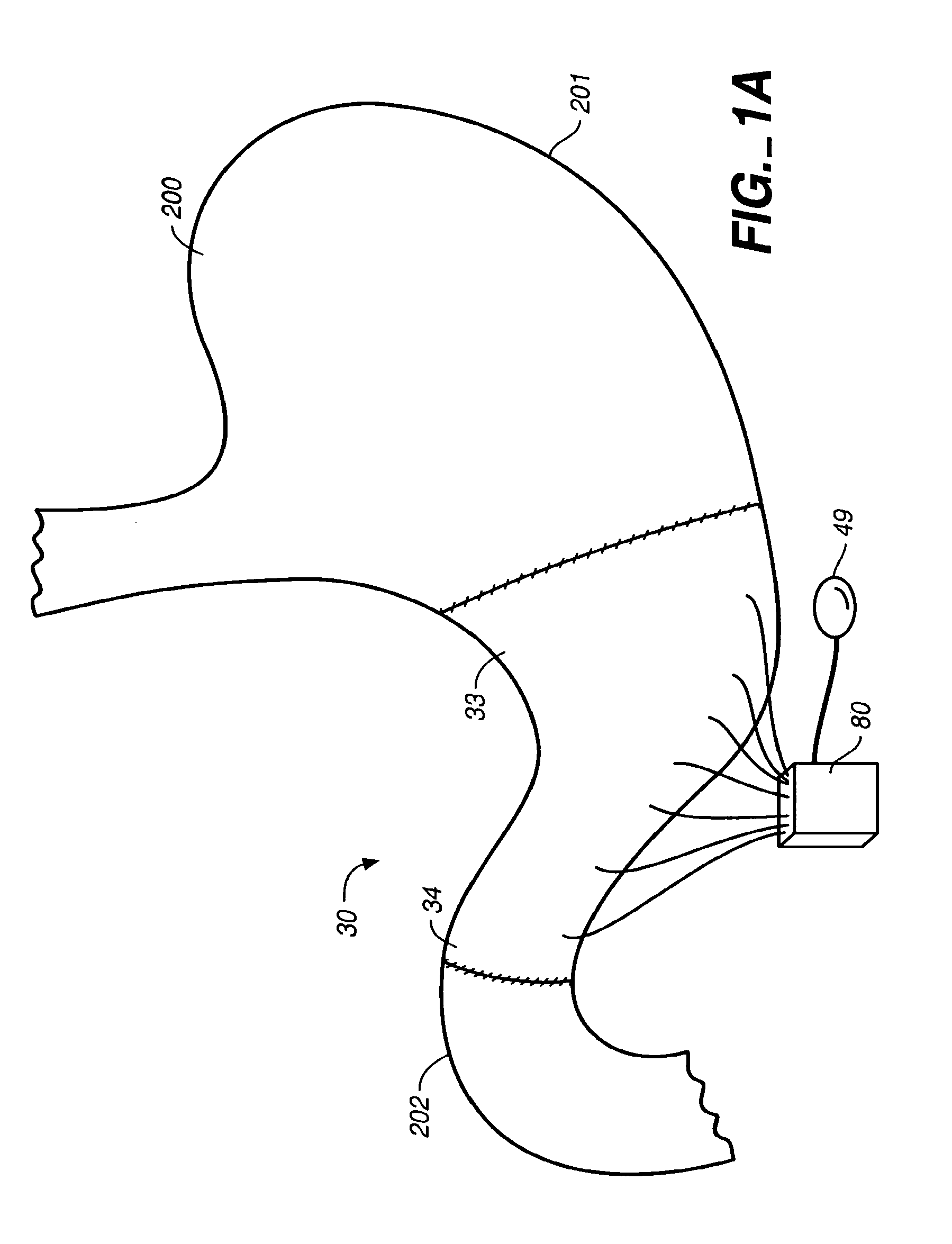 Stomach prosthesis