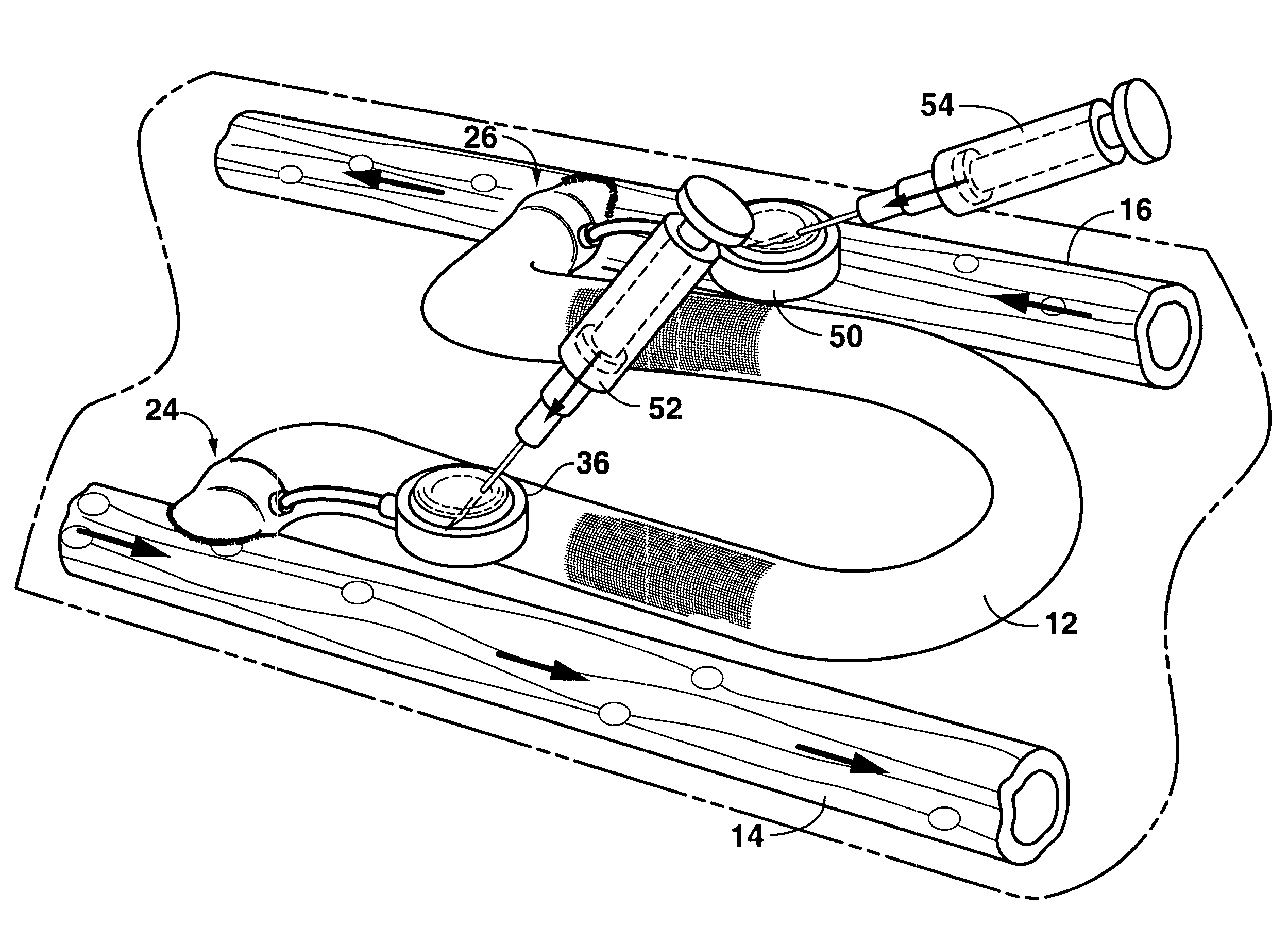 Arteriovenous access valve system and process