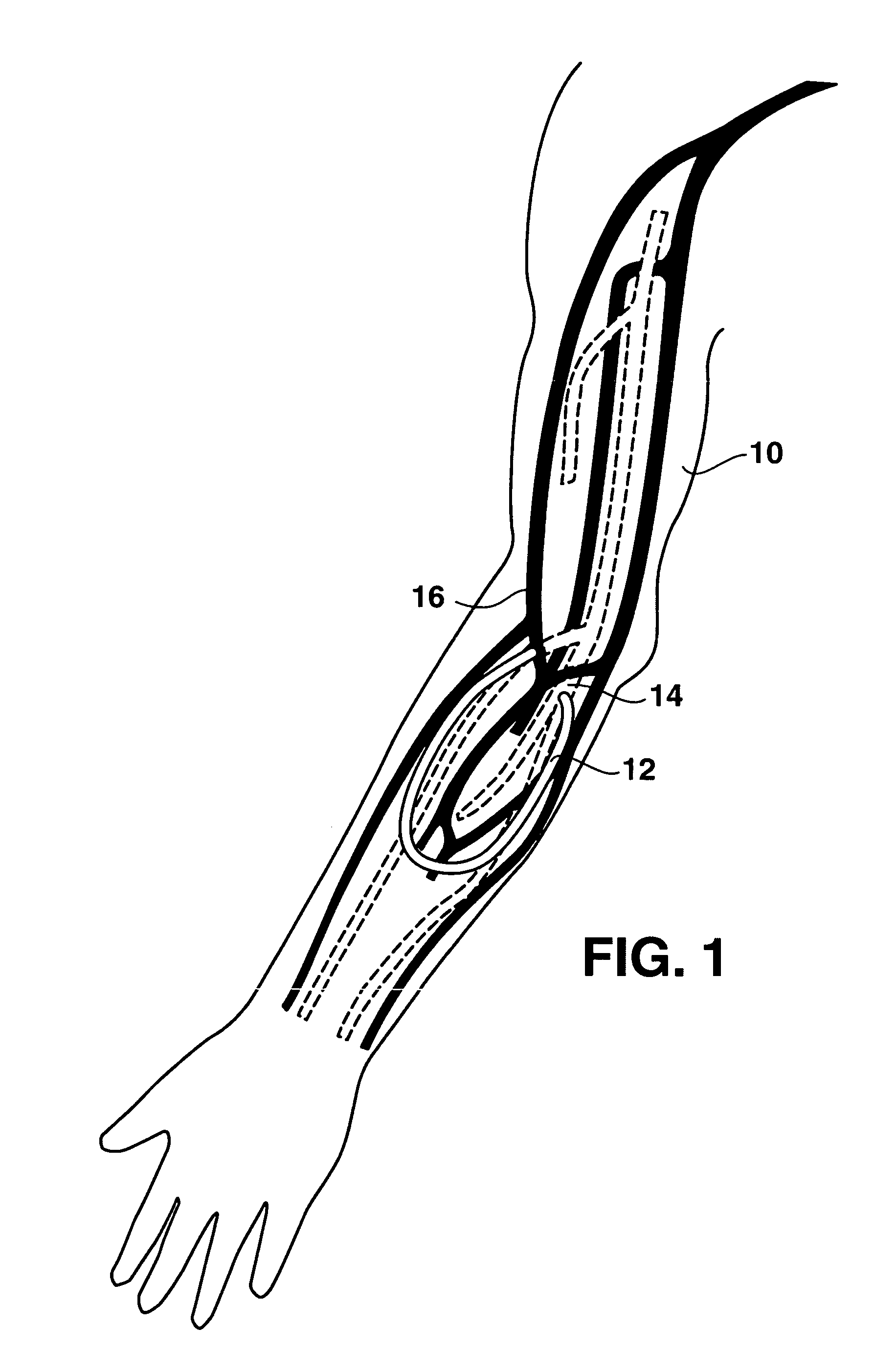 Arteriovenous access valve system and process