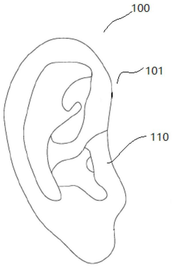 Prosthesis and prosthetic ear