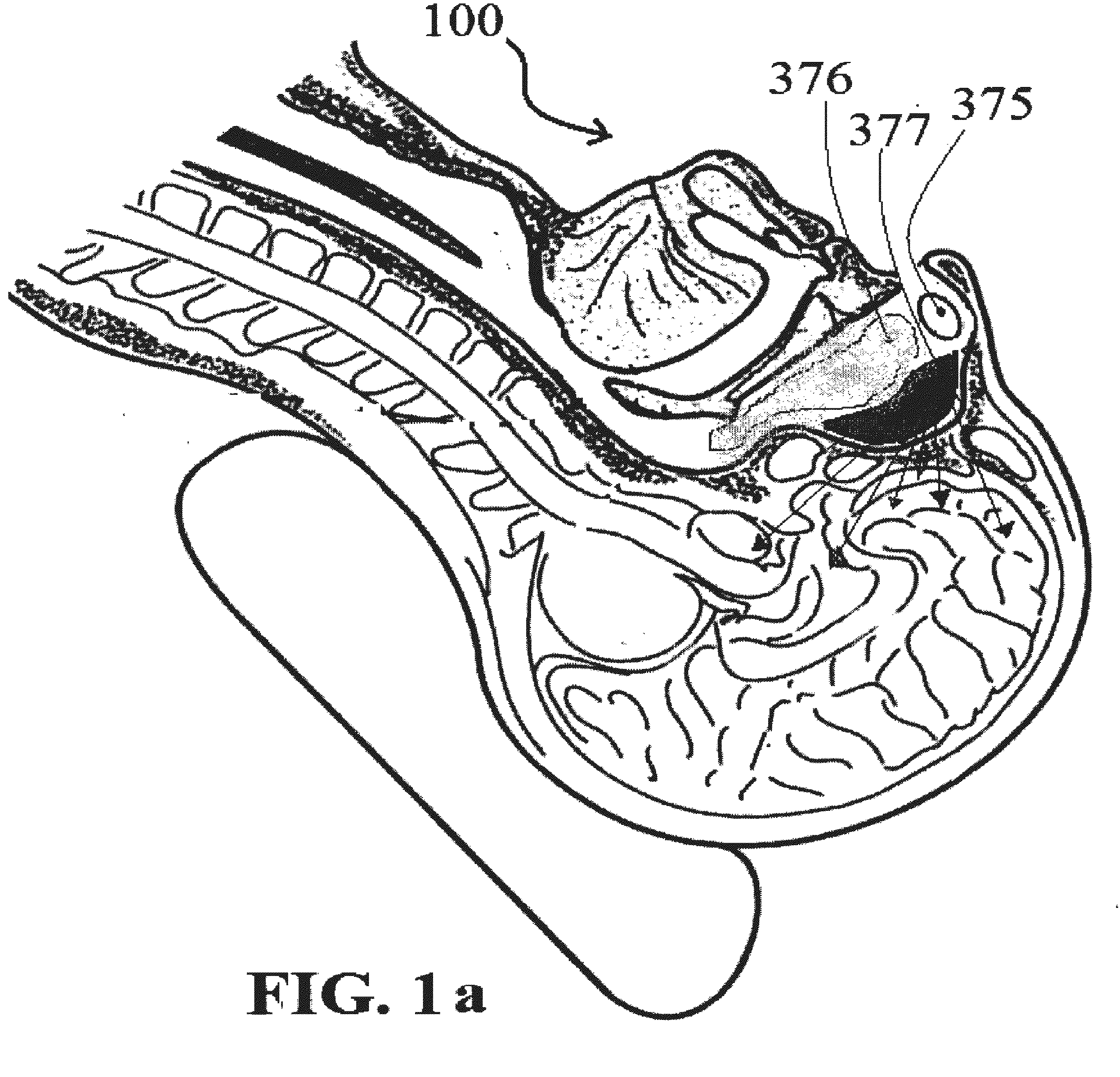 Alzheimer's disease treatment with multiple therapeutic agents delivered to the olfactory region through a special delivery catheter and iontophoresis