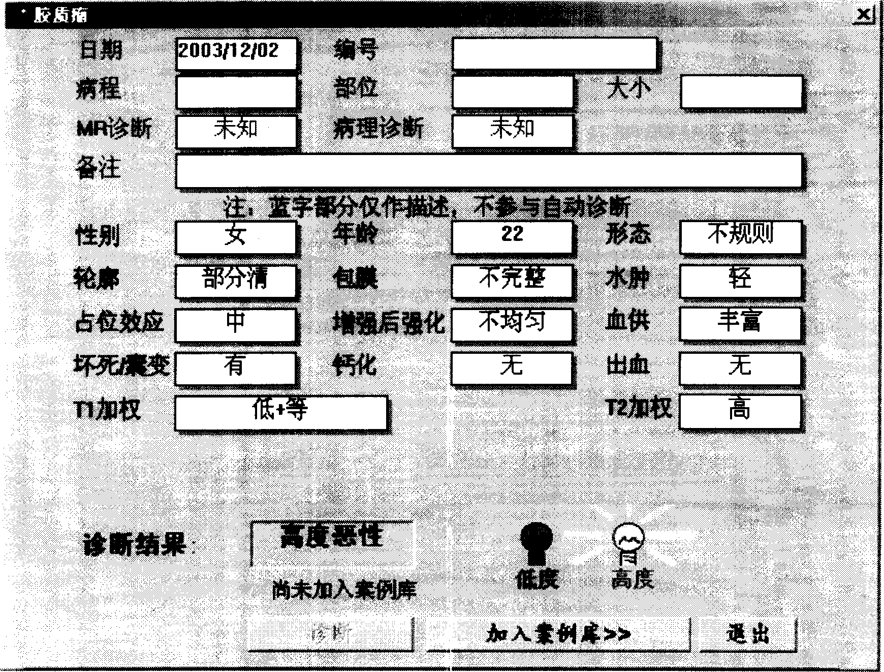 Method for implementing brain glioma computer aided diagnosis system based on data mining