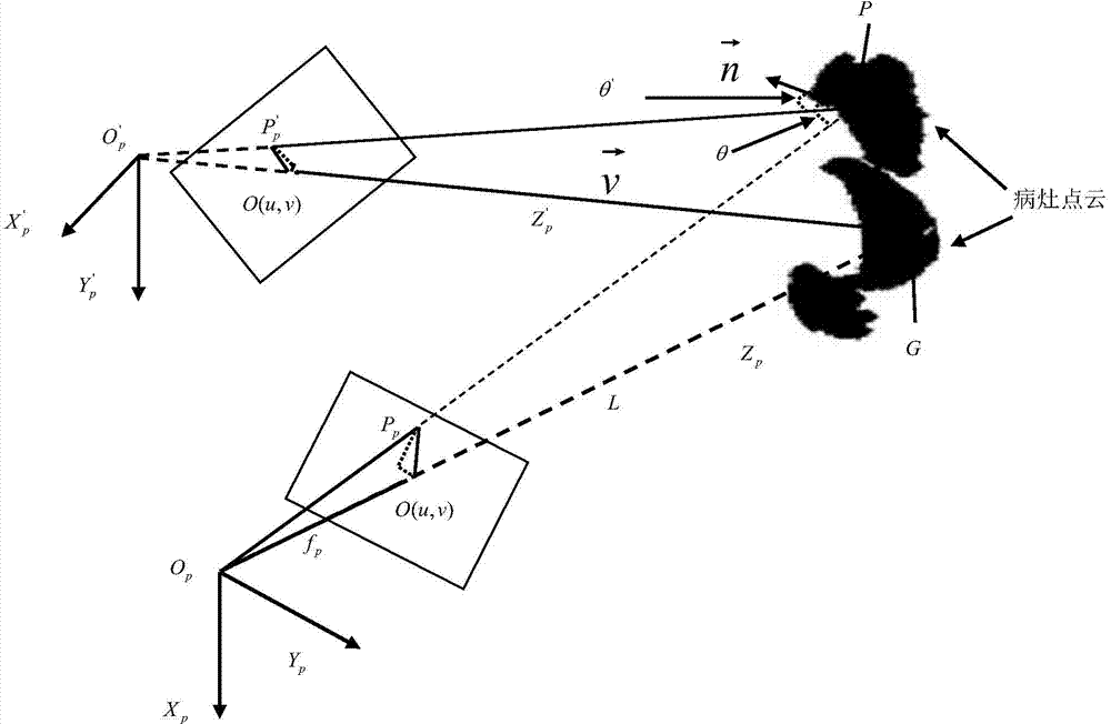 Optimization method of projection direction in PDT (Photodynamics Therapy)