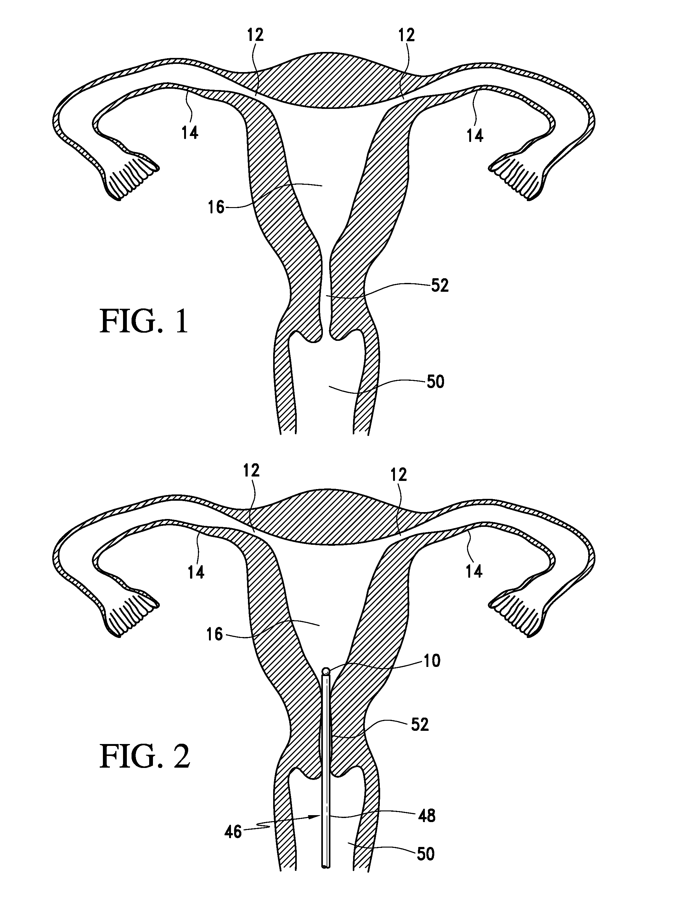 Intrauterine fallopian tube occlusion device