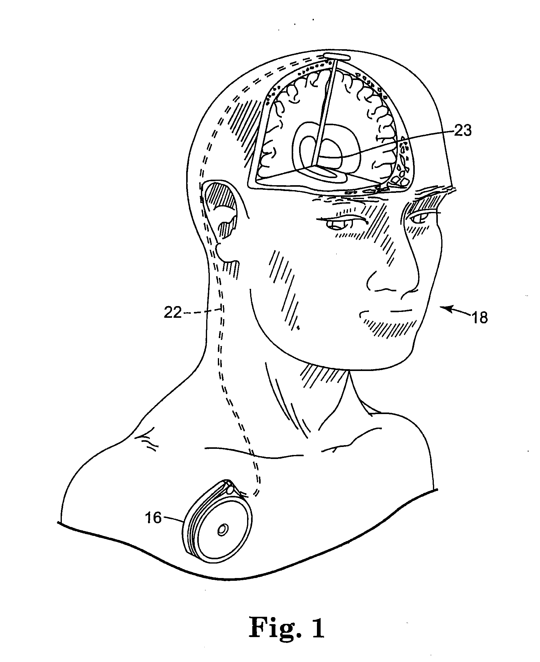 External power source for an implantable medical device having an adjustable carrier frequency and system and method related therefore