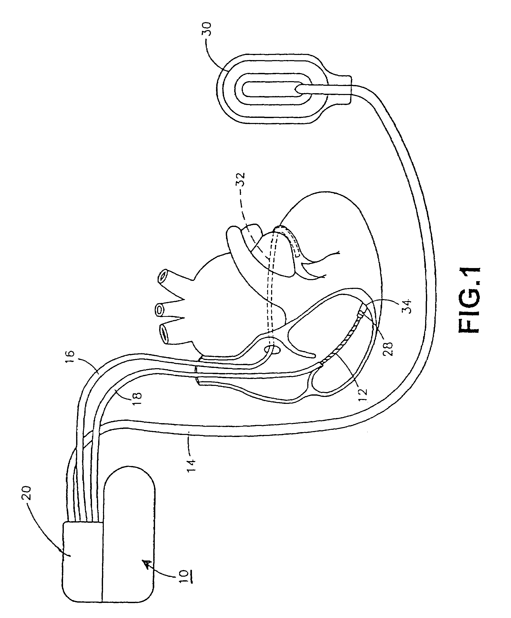 Implantable medical device having flat electrolytic capacitor with differing sized anode and cathode layers