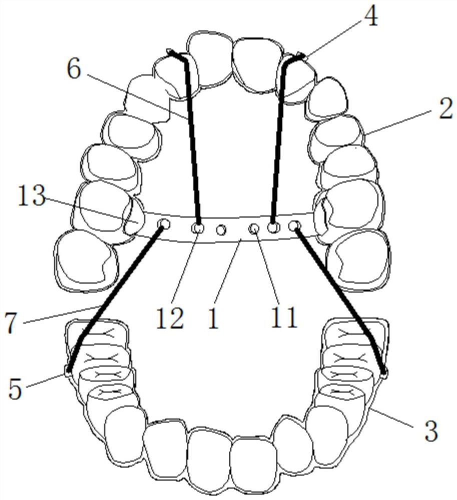 Force application device and method based on invisible correction of tooth extraction case