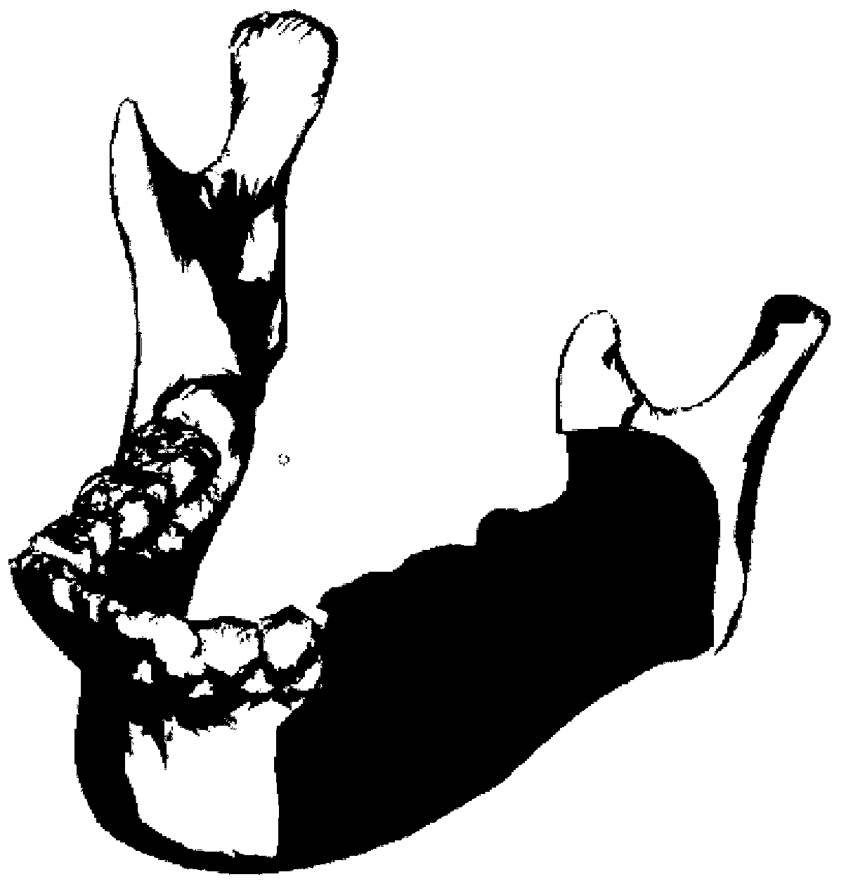 Manufacturing method of individualized stent for repairing defect of more than four tooth positions on one side of low jawbone