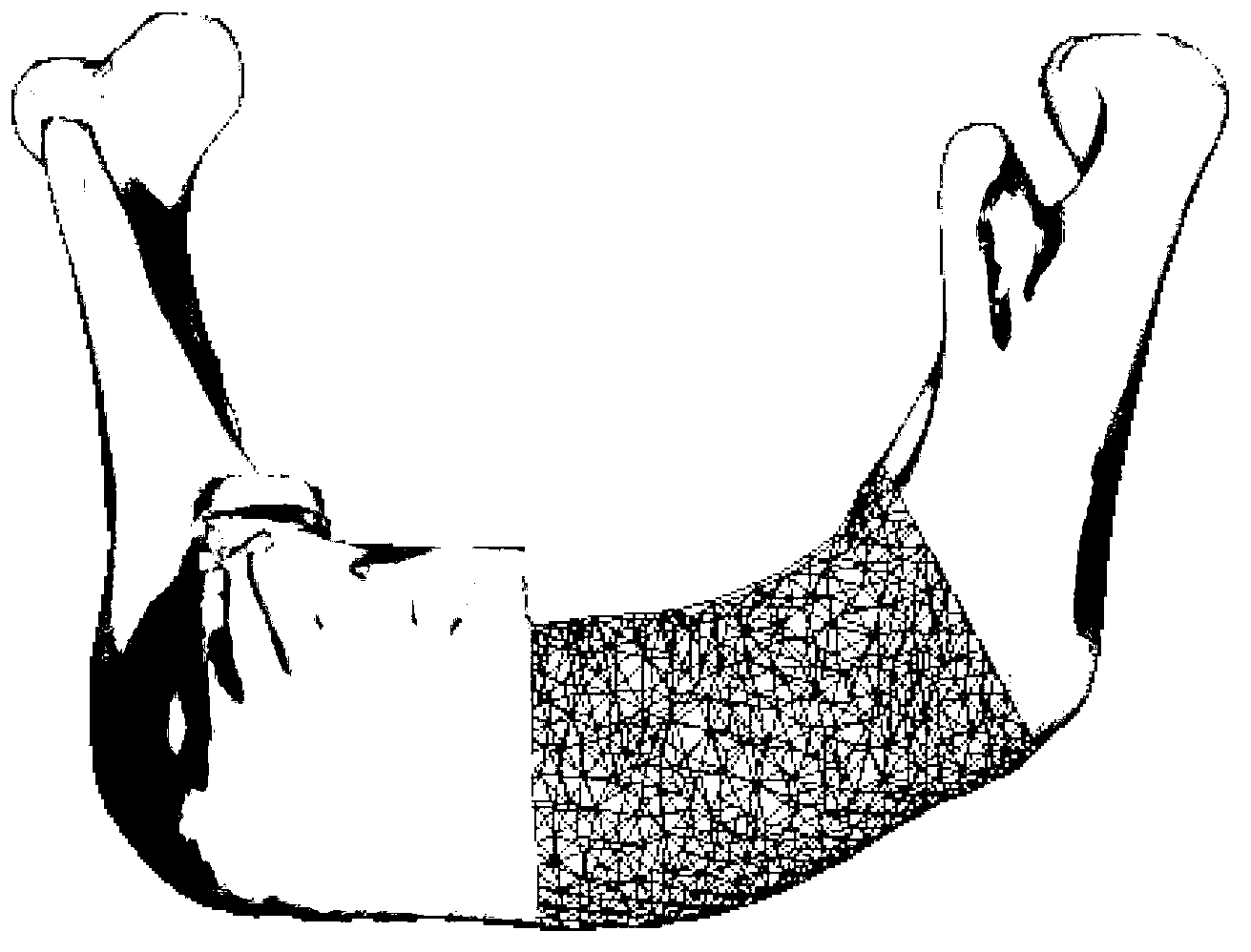 Manufacturing method of individualized stent for repairing defect of more than four tooth positions on one side of low jawbone