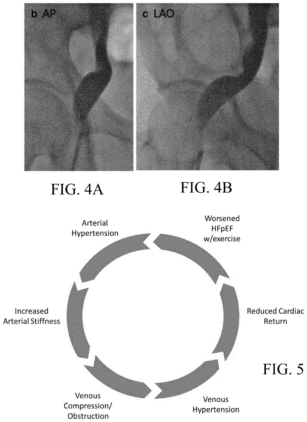 Systems and methods for treating venous compression/obstruction syndromes