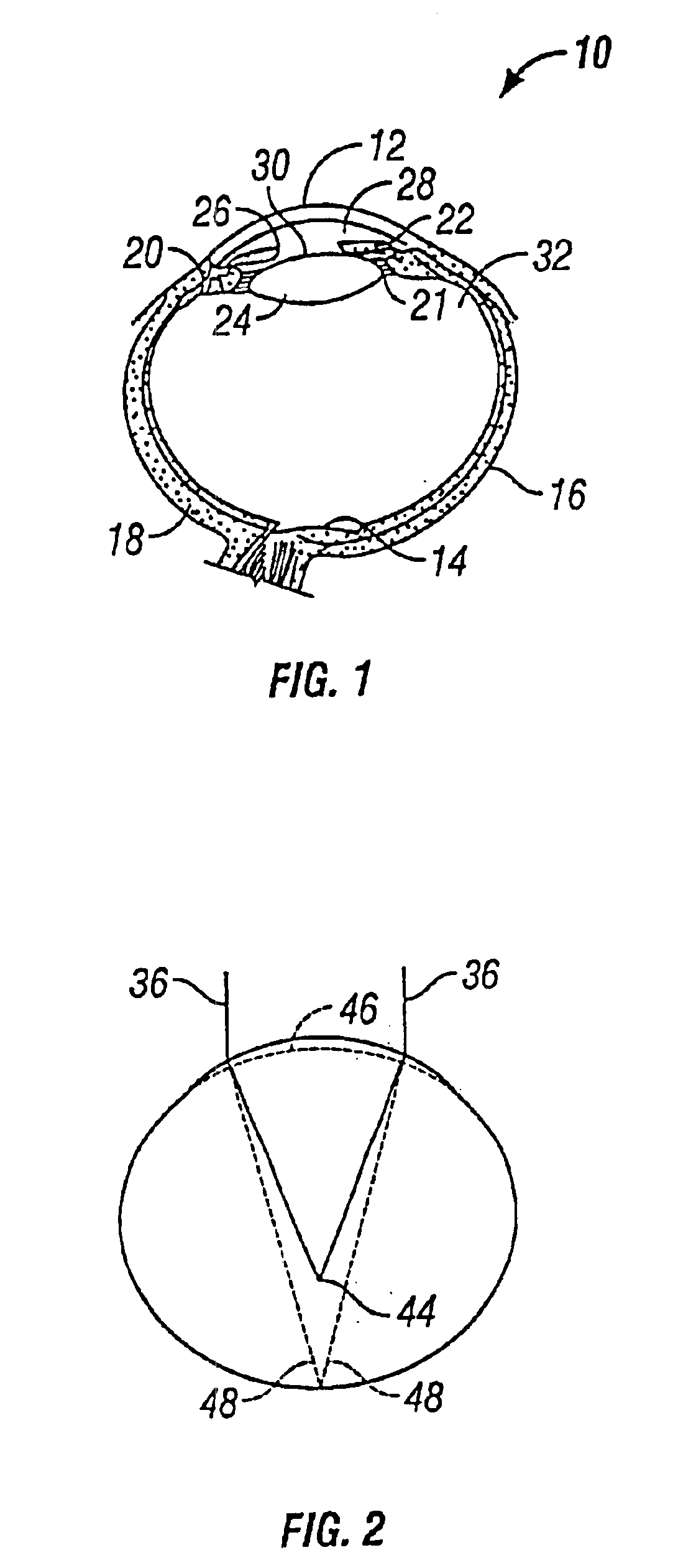 Myopic corneal ring with central accommodating portion