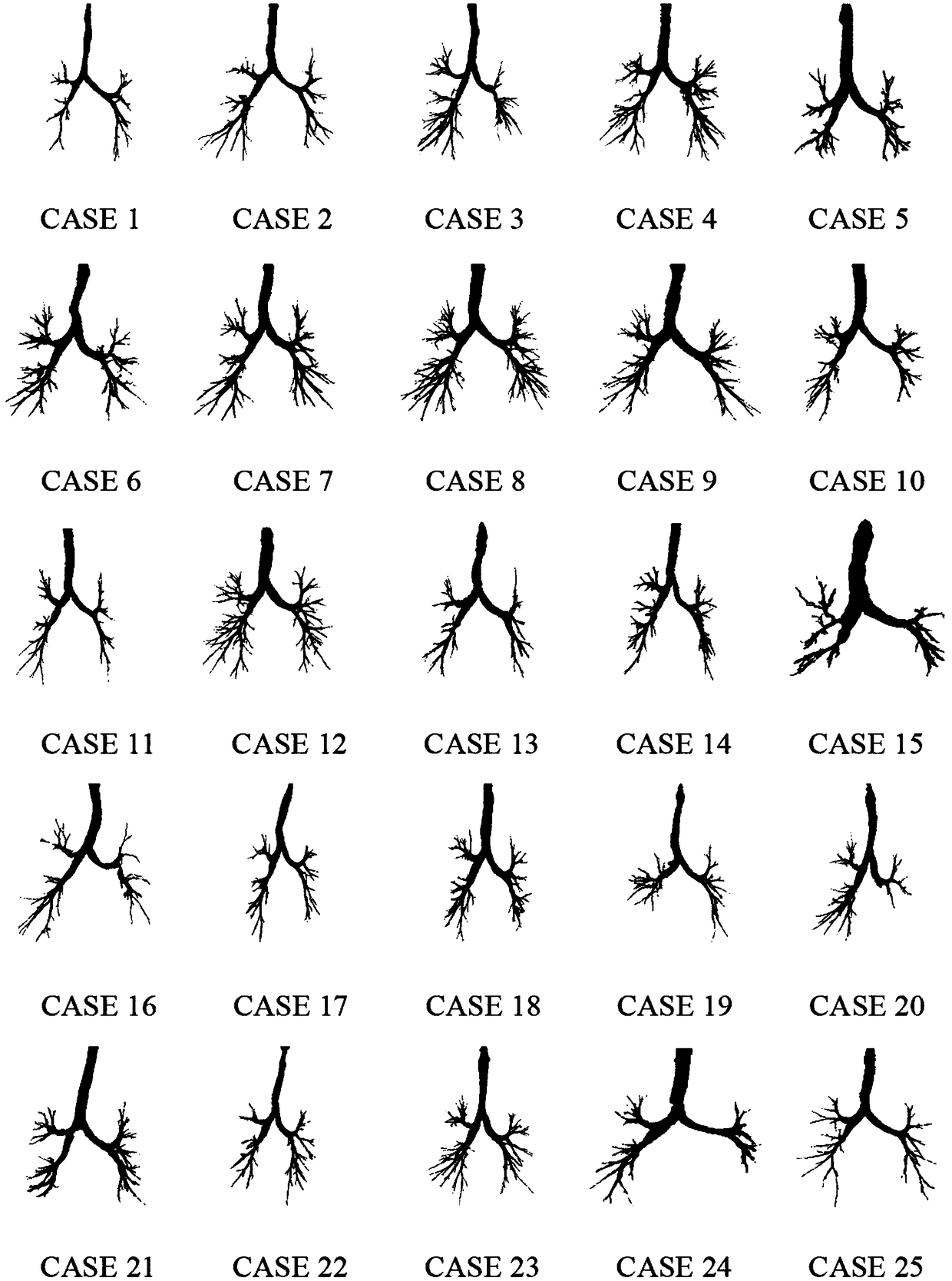 Pulmonary Tracheal Tree Segmentation Method Based on Two-stroke Region Growing Combined with Morphological Reconstruction