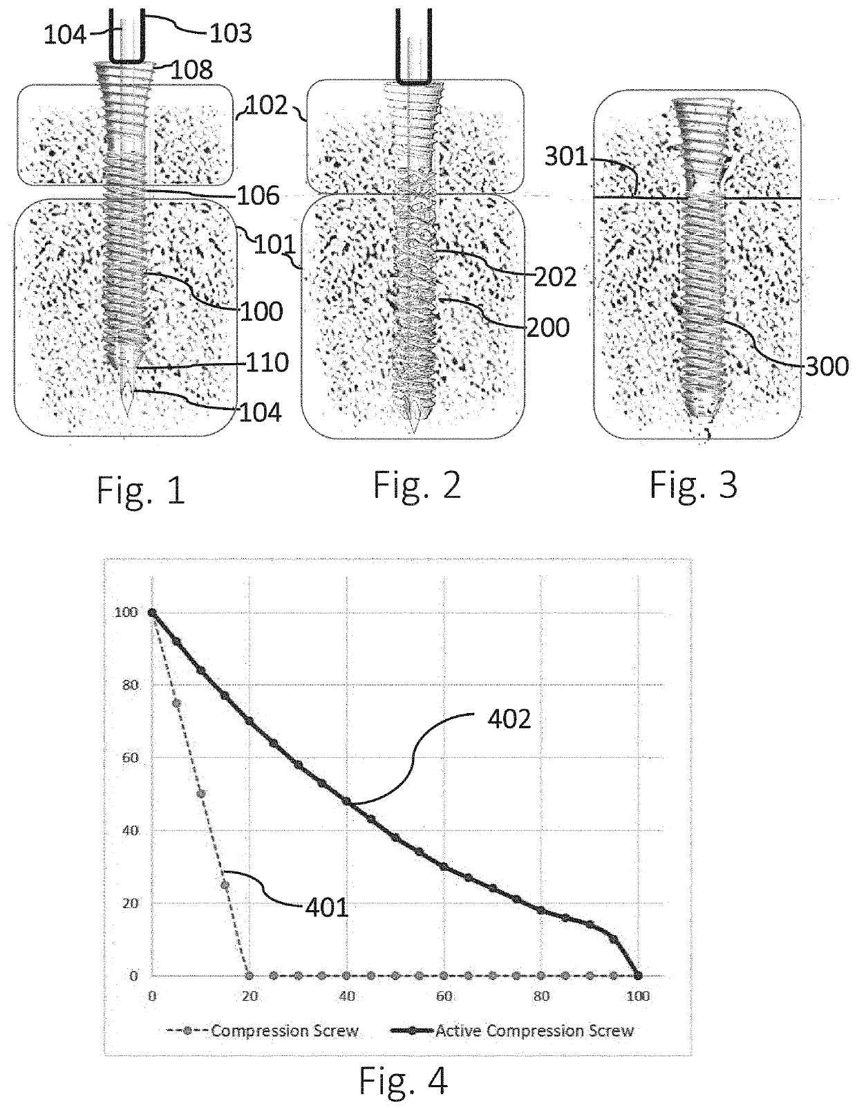 Active Compression Apparatus, Methods Of Assembly And Methods Of Use