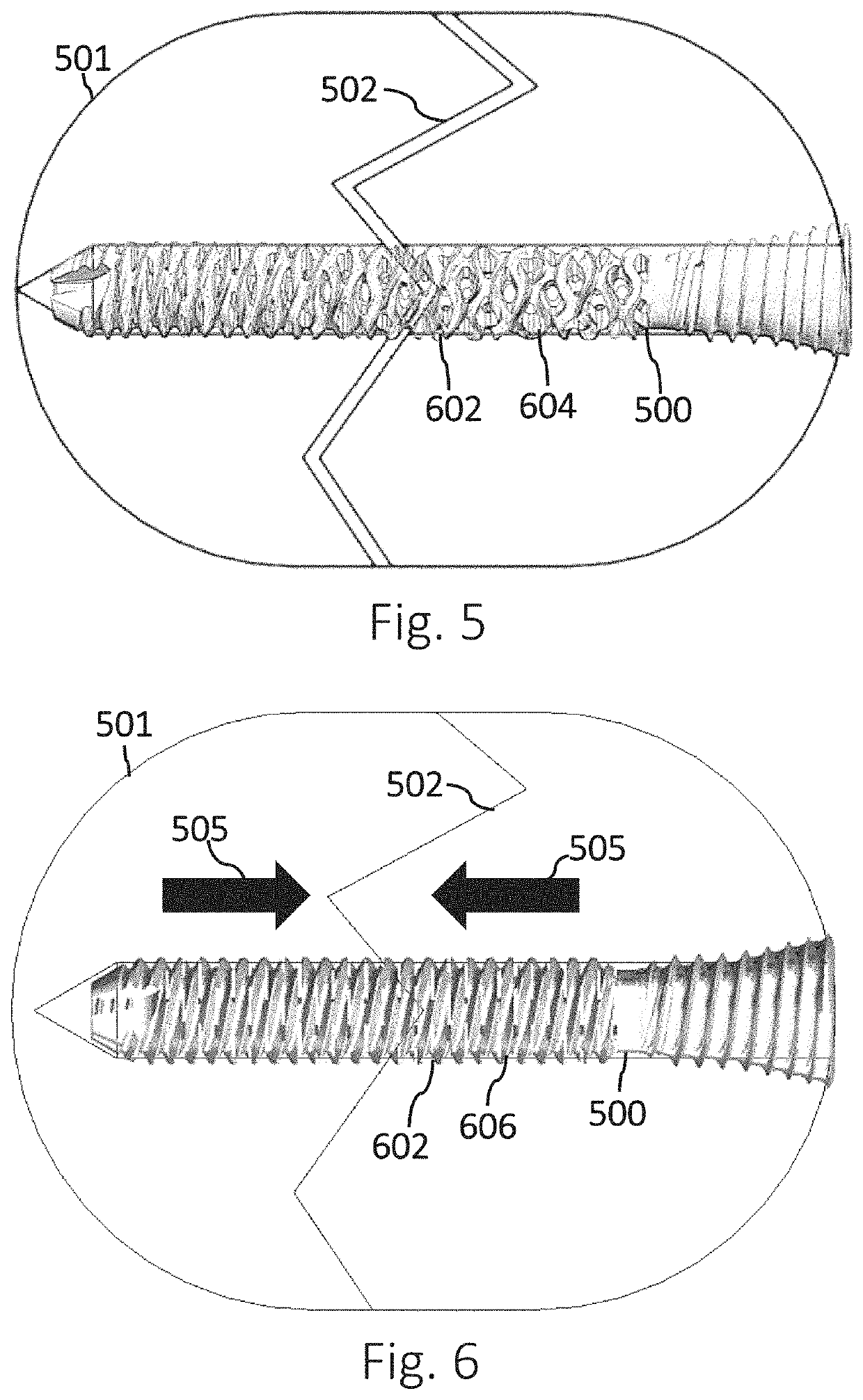 Active Compression Apparatus, Methods Of Assembly And Methods Of Use