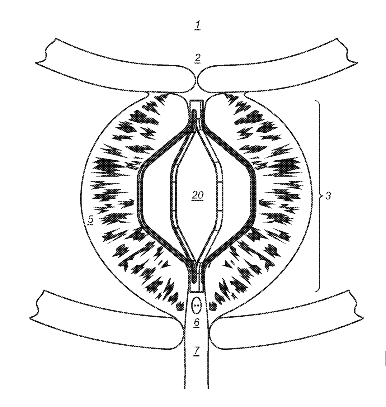 Implantable devices and methods to treat benign prostate hyperplasia (BPH) and associated lower urinary tract symptoms (LUTS)