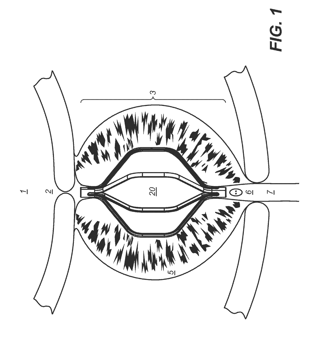 Implantable devices and methods to treat benign prostate hyperplasia (BPH) and associated lower urinary tract symptoms (LUTS)