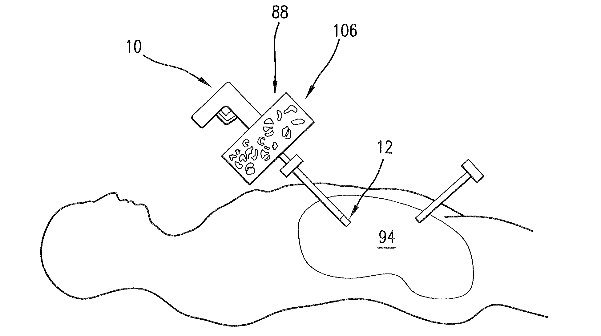 Medical device and method for human tissue and foreign body extraction