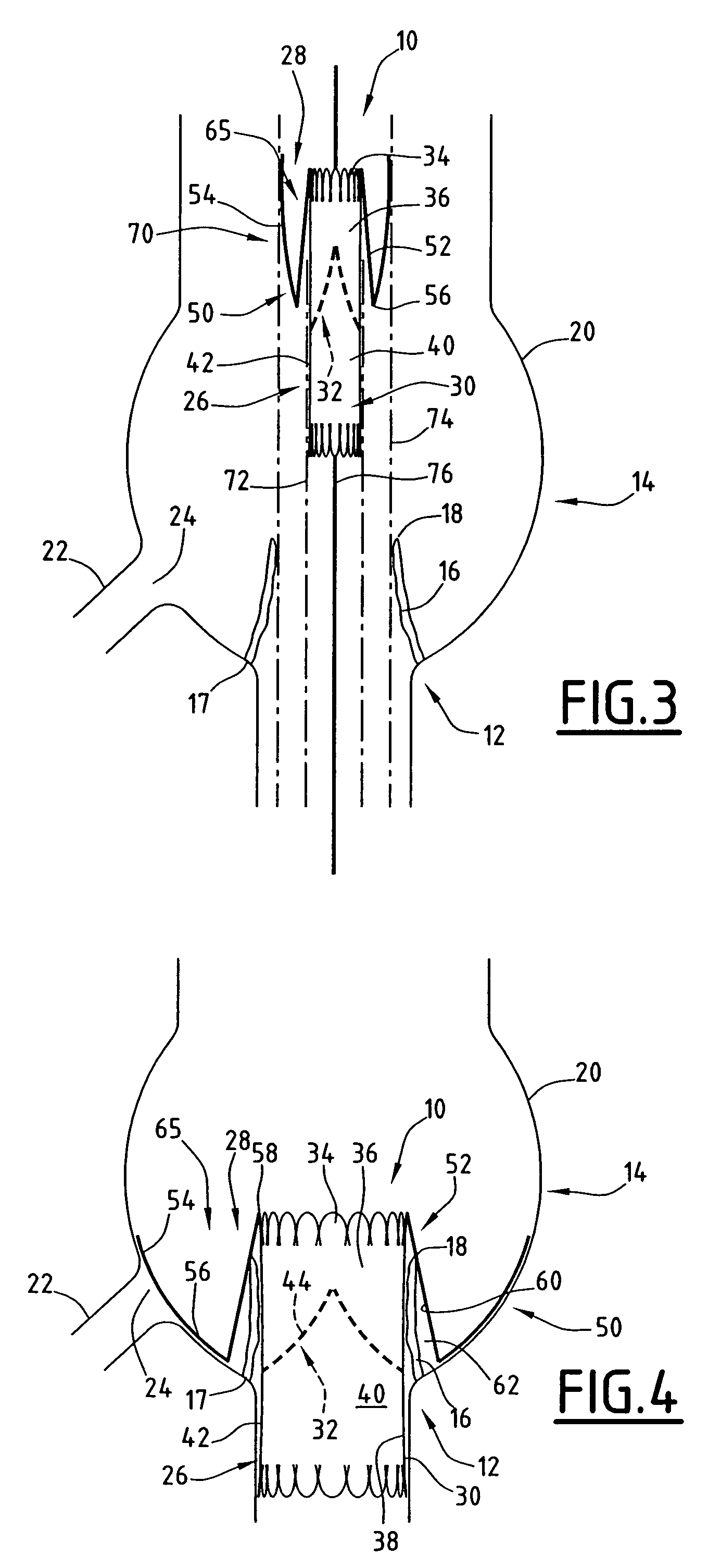 Implant which is intended to be placed in a blood vessel