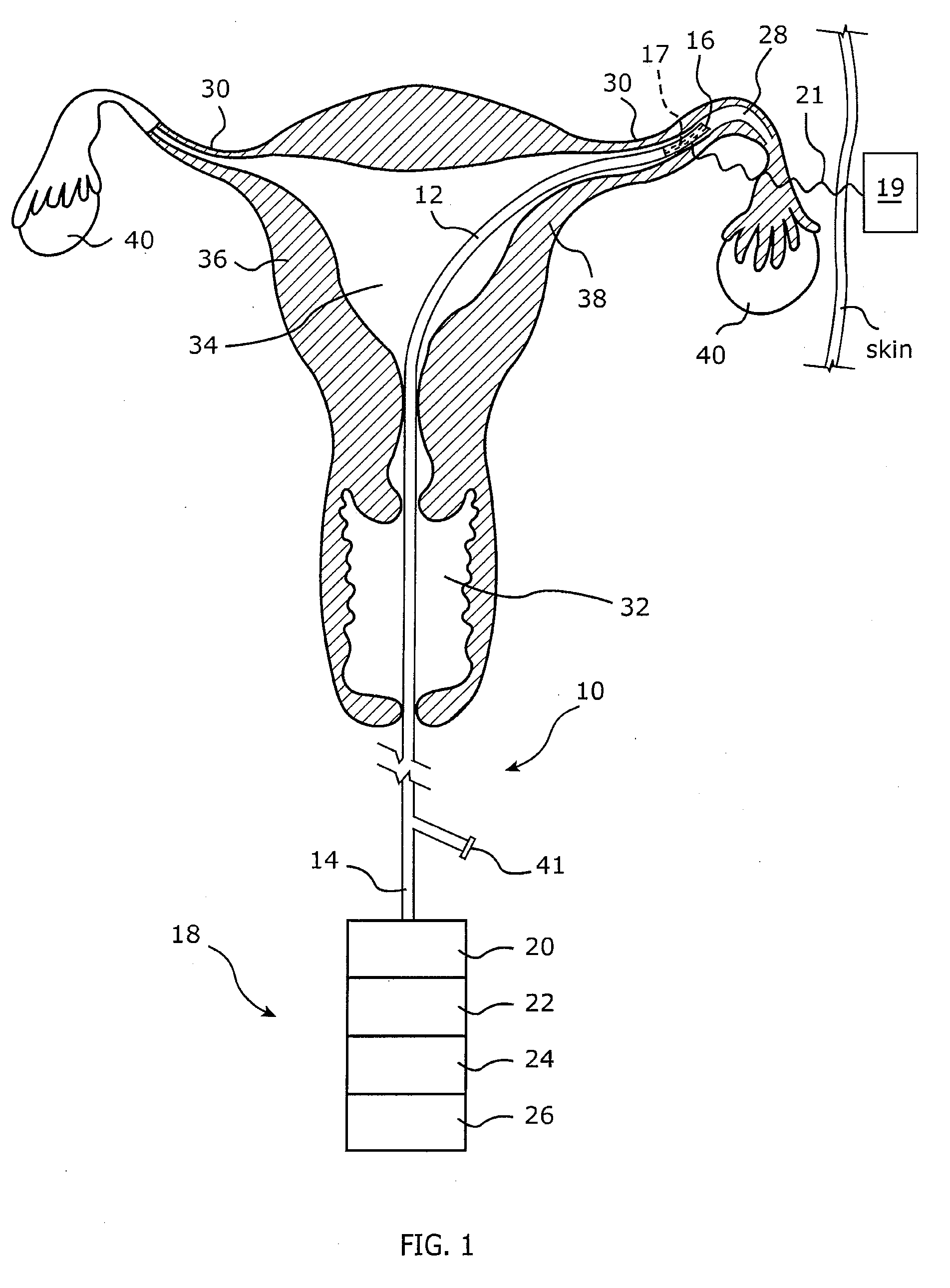 Tubal ligation