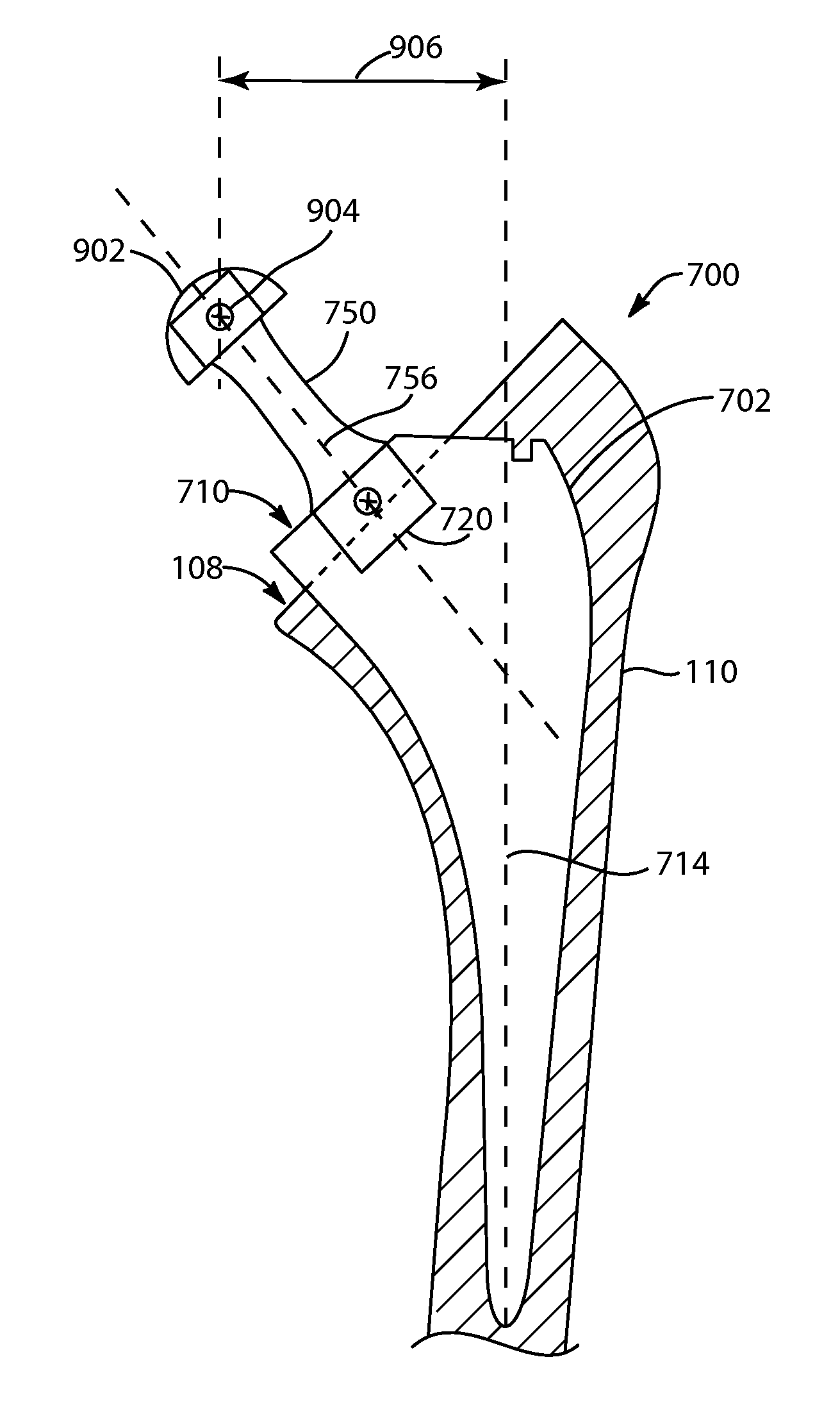 Prosthetic femoral stem for use in high offset hip replacement