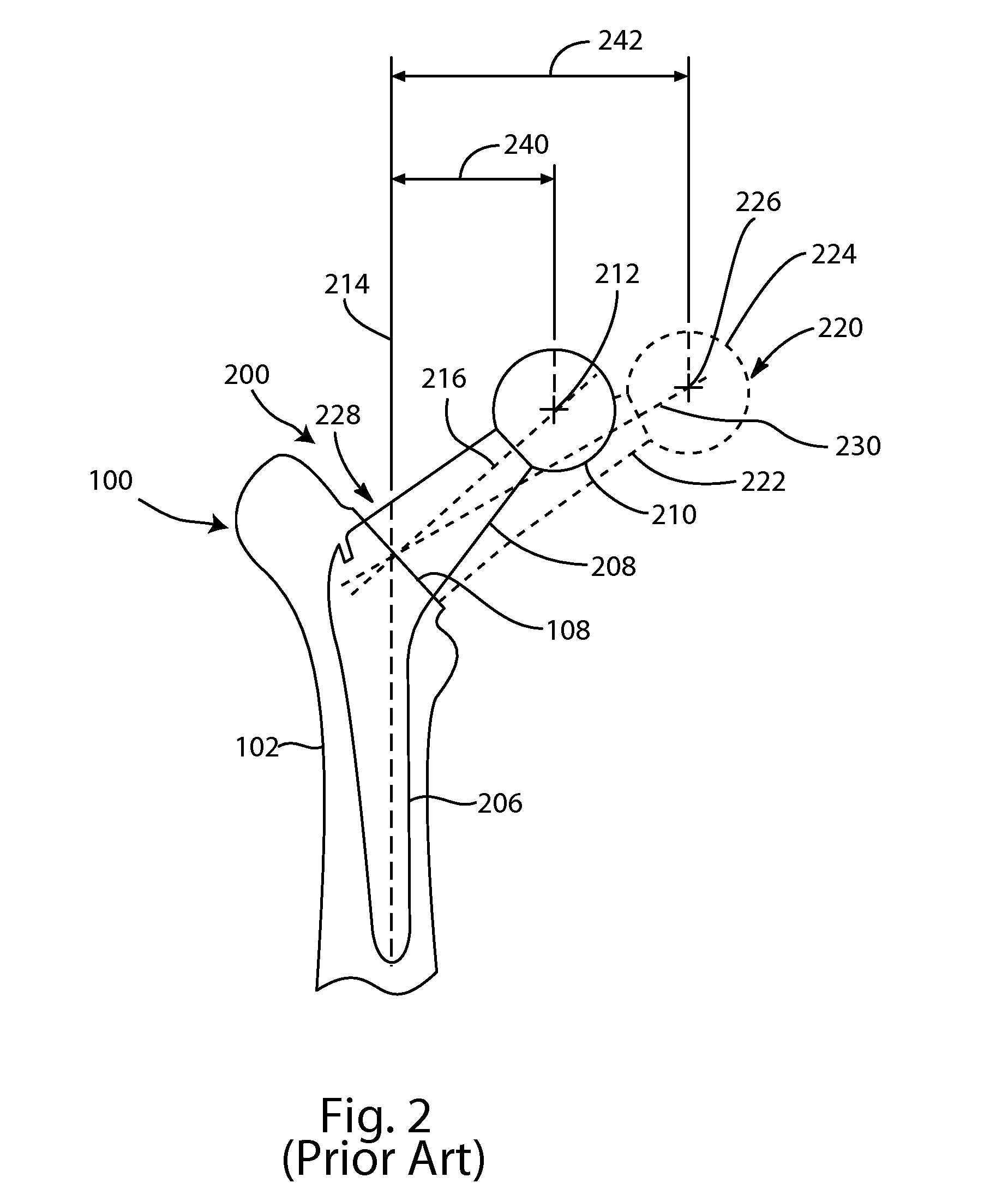 Prosthetic femoral stem for use in high offset hip replacement