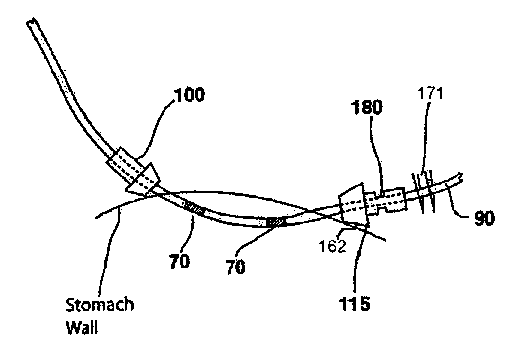 Implantable medical device with captivation fixation