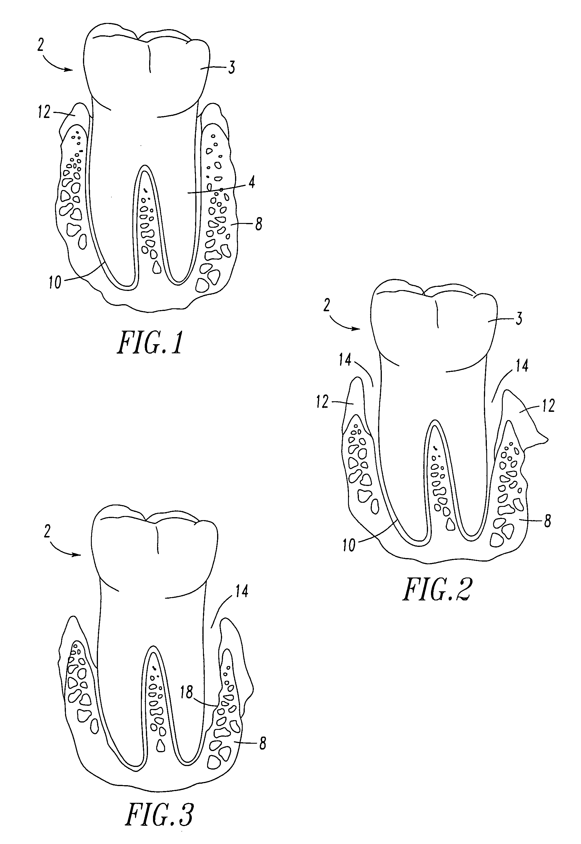 Periodontal regeneration composition and method of using same