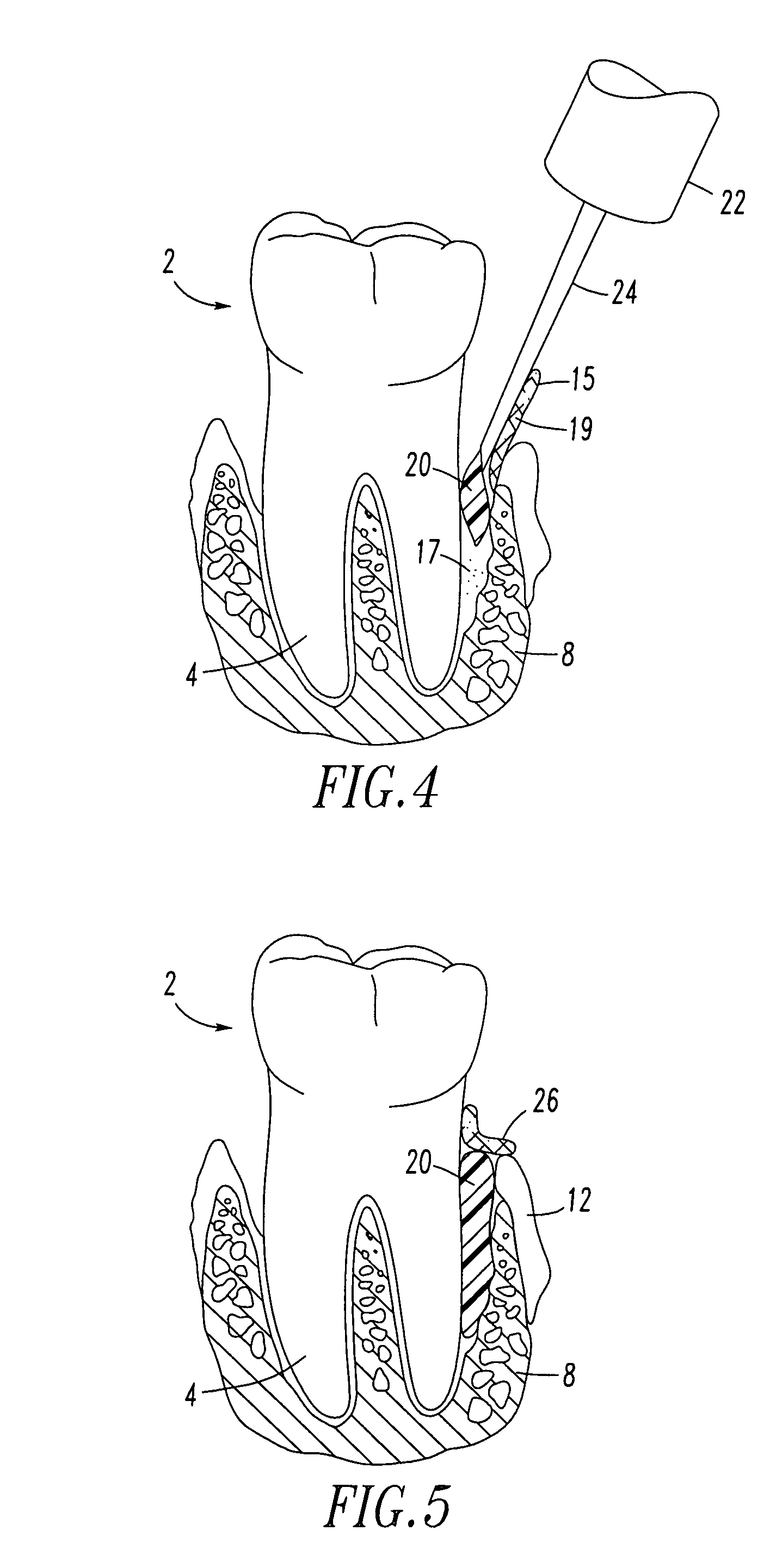 Periodontal regeneration composition and method of using same