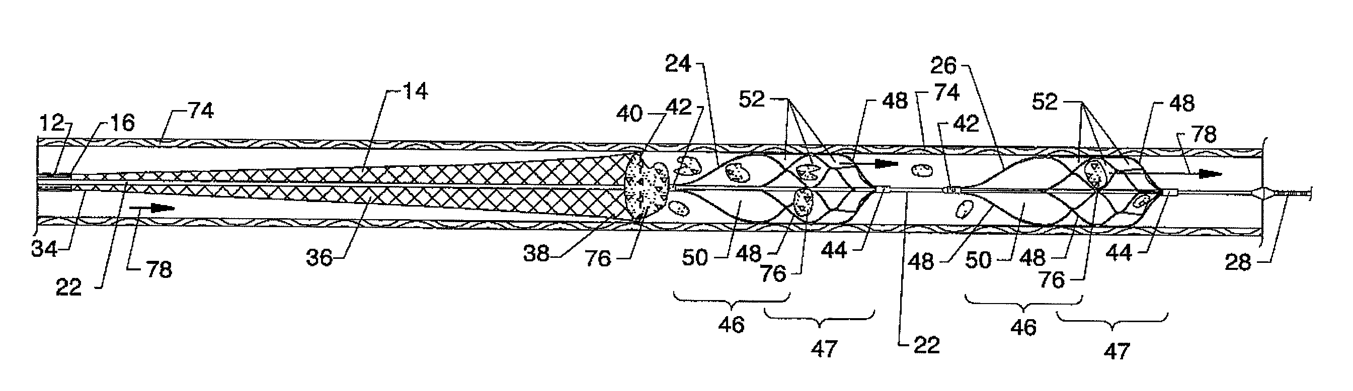 Intravascular guidewire filter system for pulmonary embolism protection and embolism removal or maceration