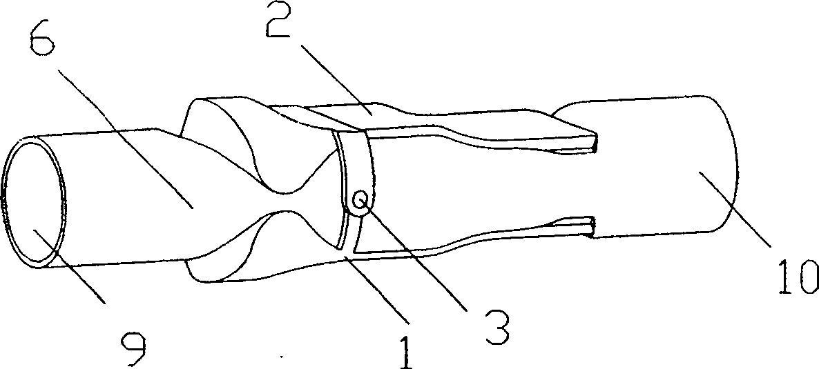 Indirect artificial valva outside vein