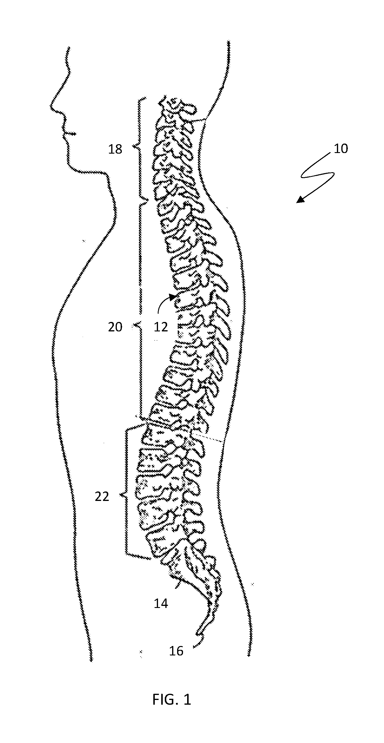 Odontoid bullet