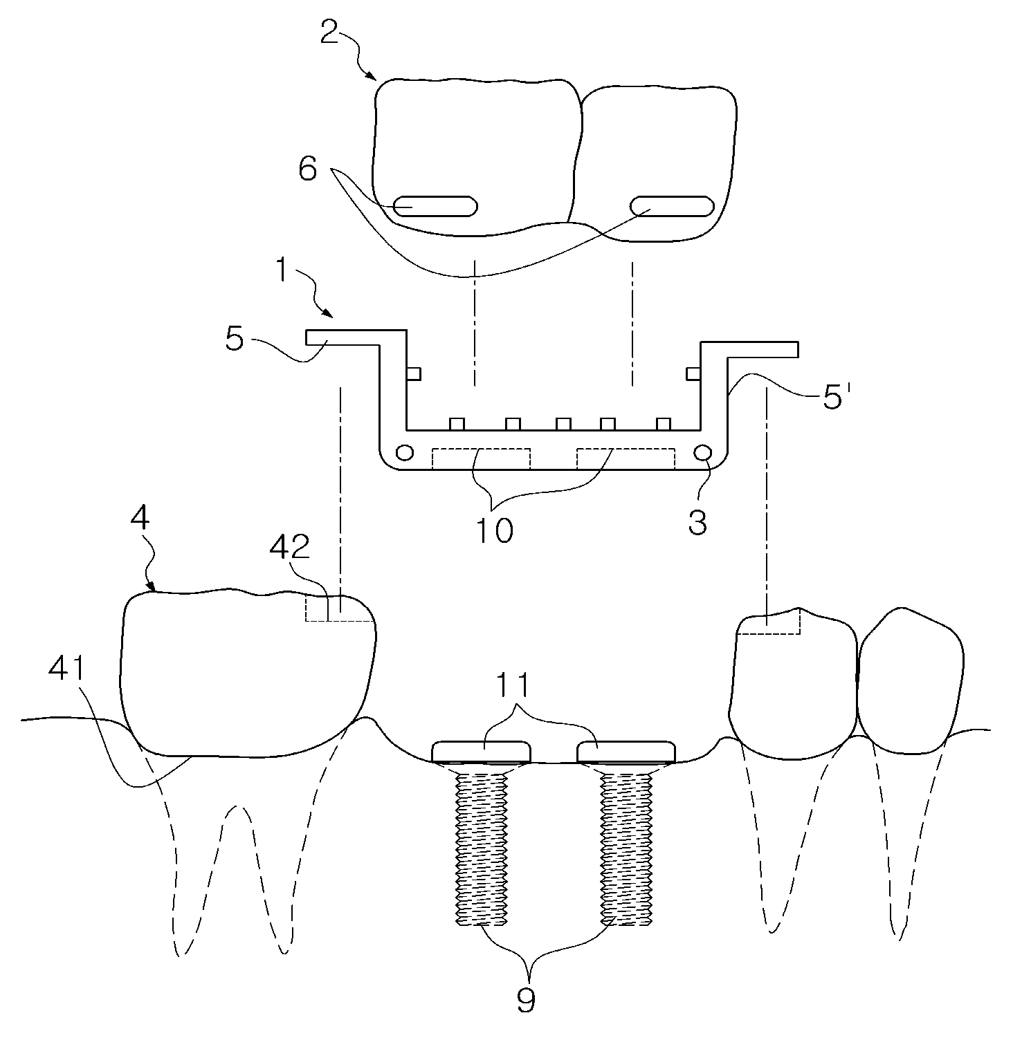 Instant dental bridge