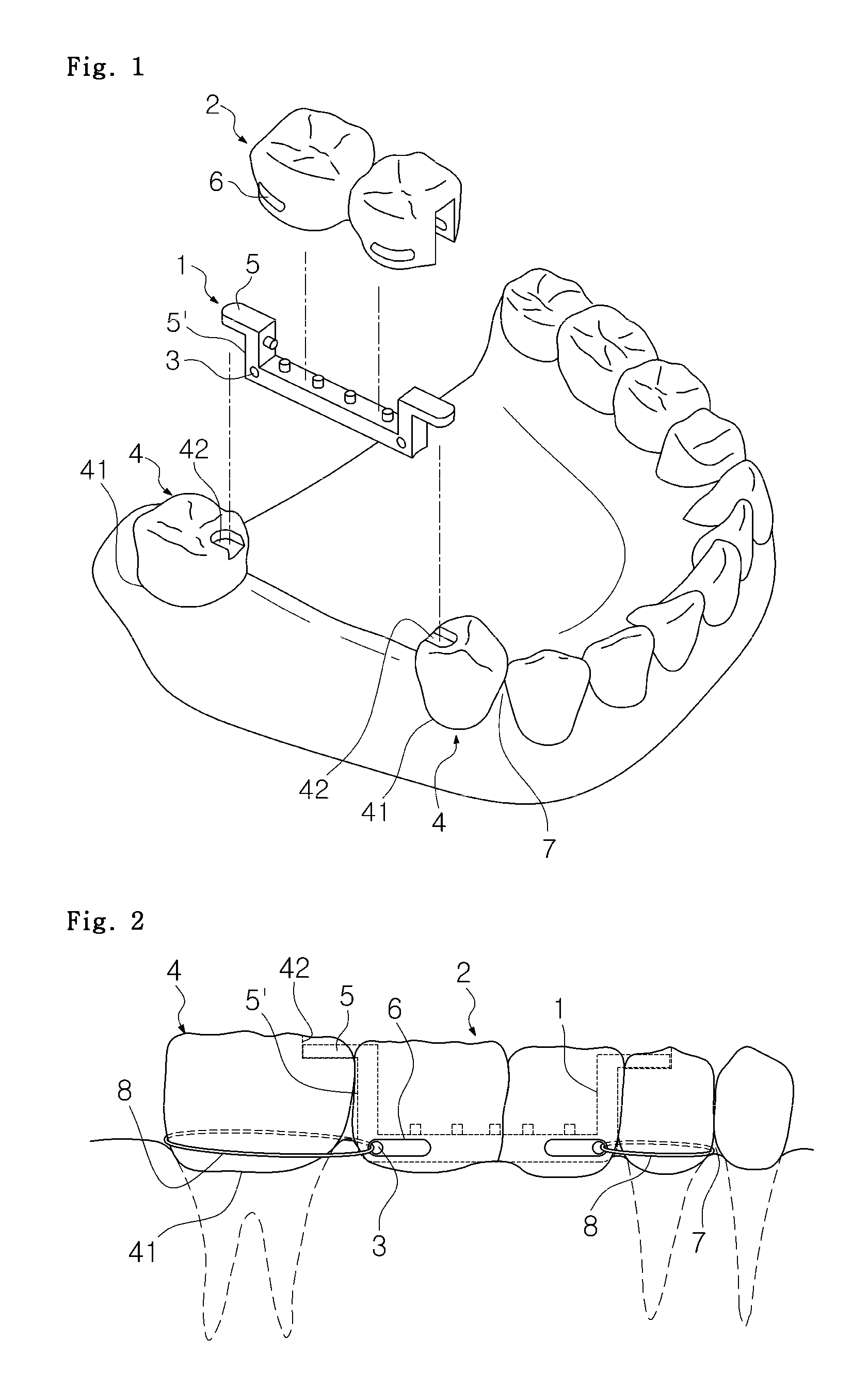 Instant dental bridge