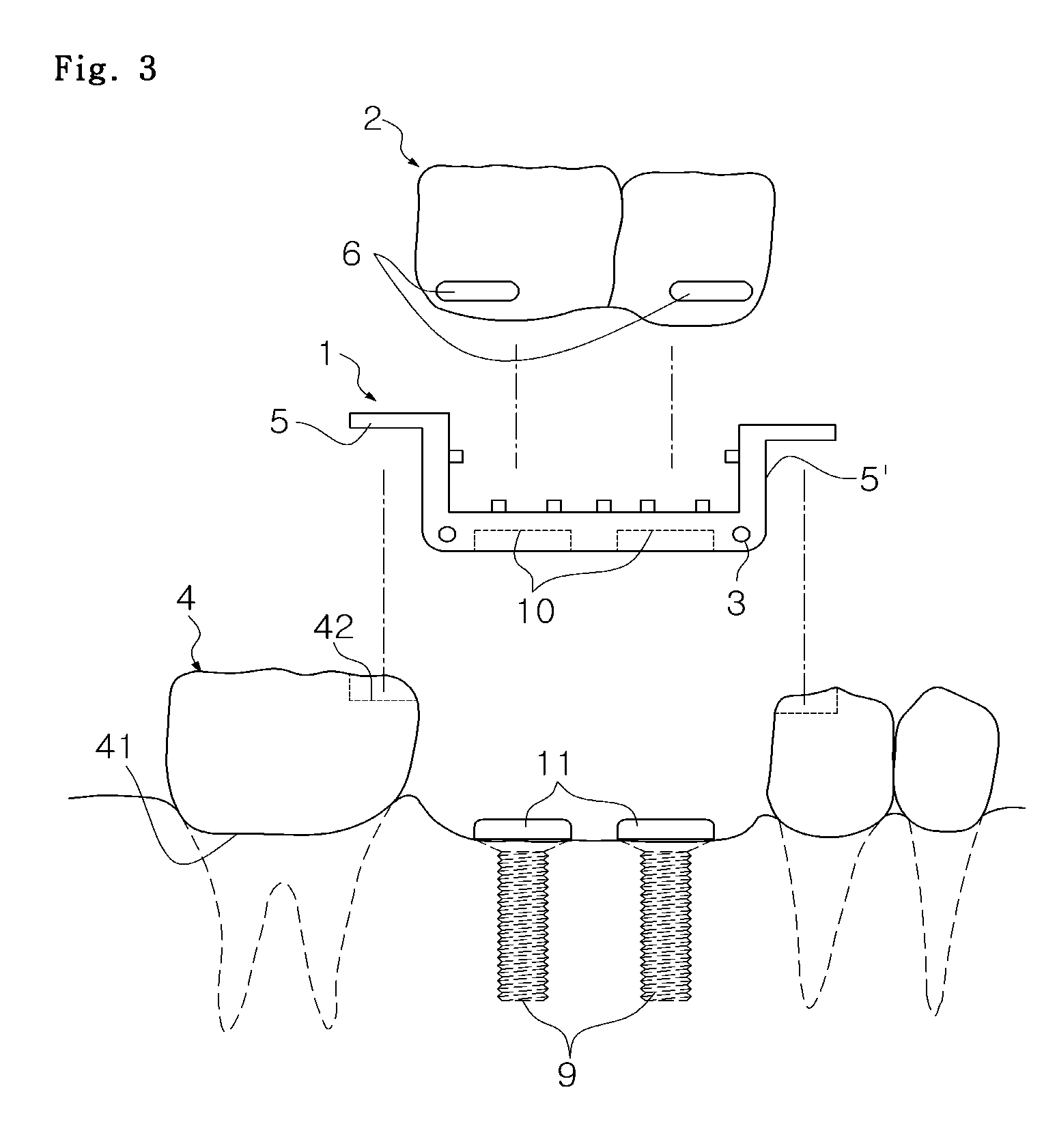 Instant dental bridge