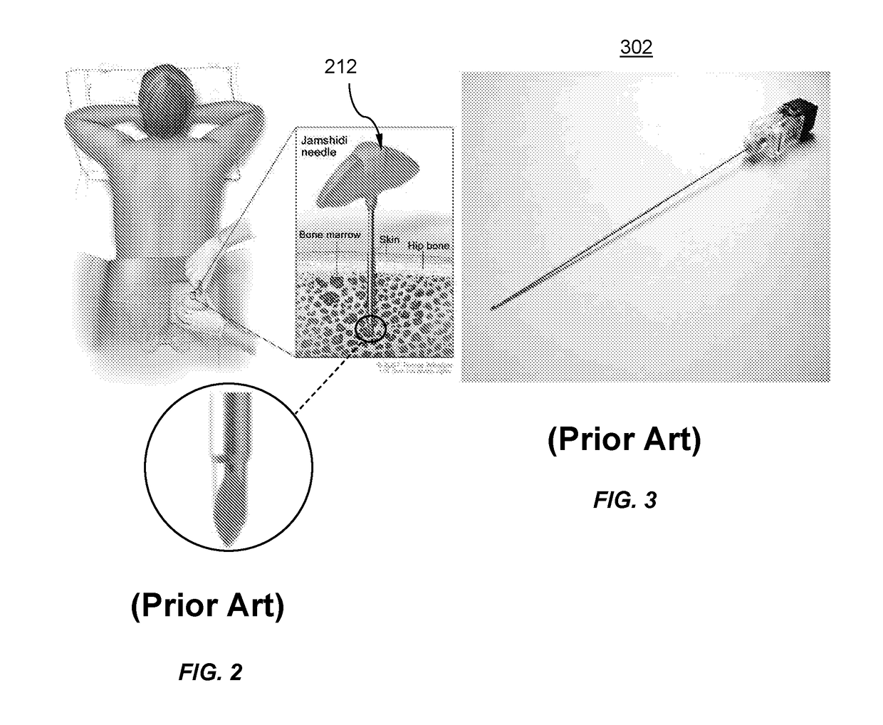 Integrated painless bone marrow biopsy device