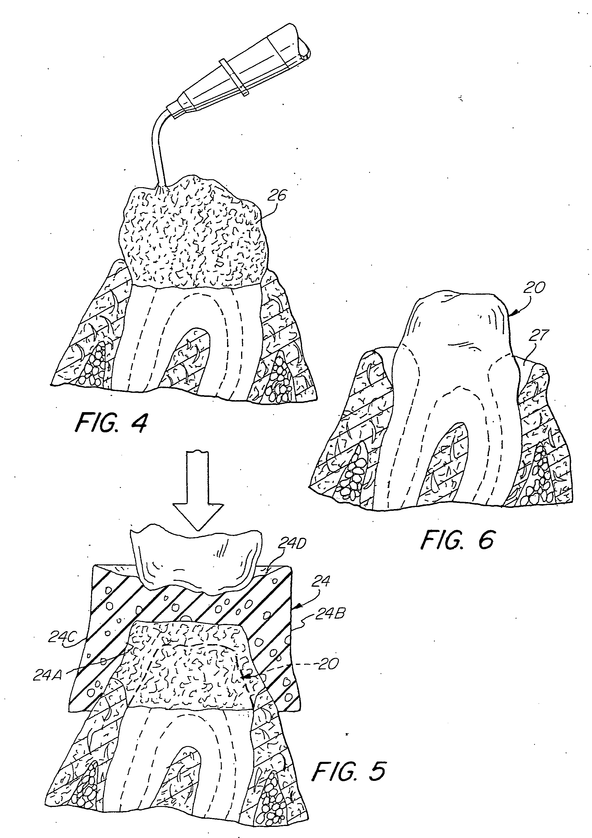 Method and device for the retraction and hemostasis of tissue during crown and bridge procedures