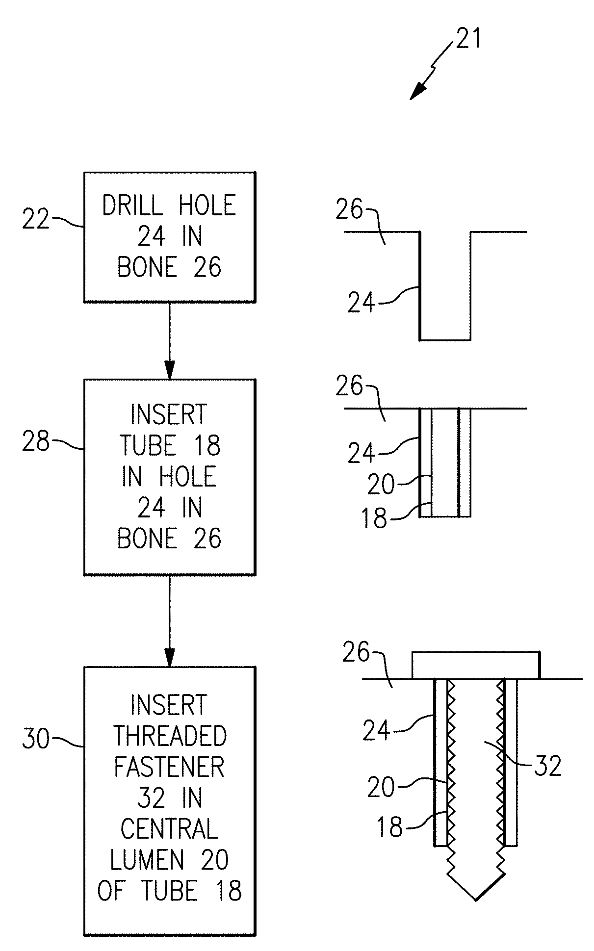 Three dimensional spacer fabric to increase the holding power of screws