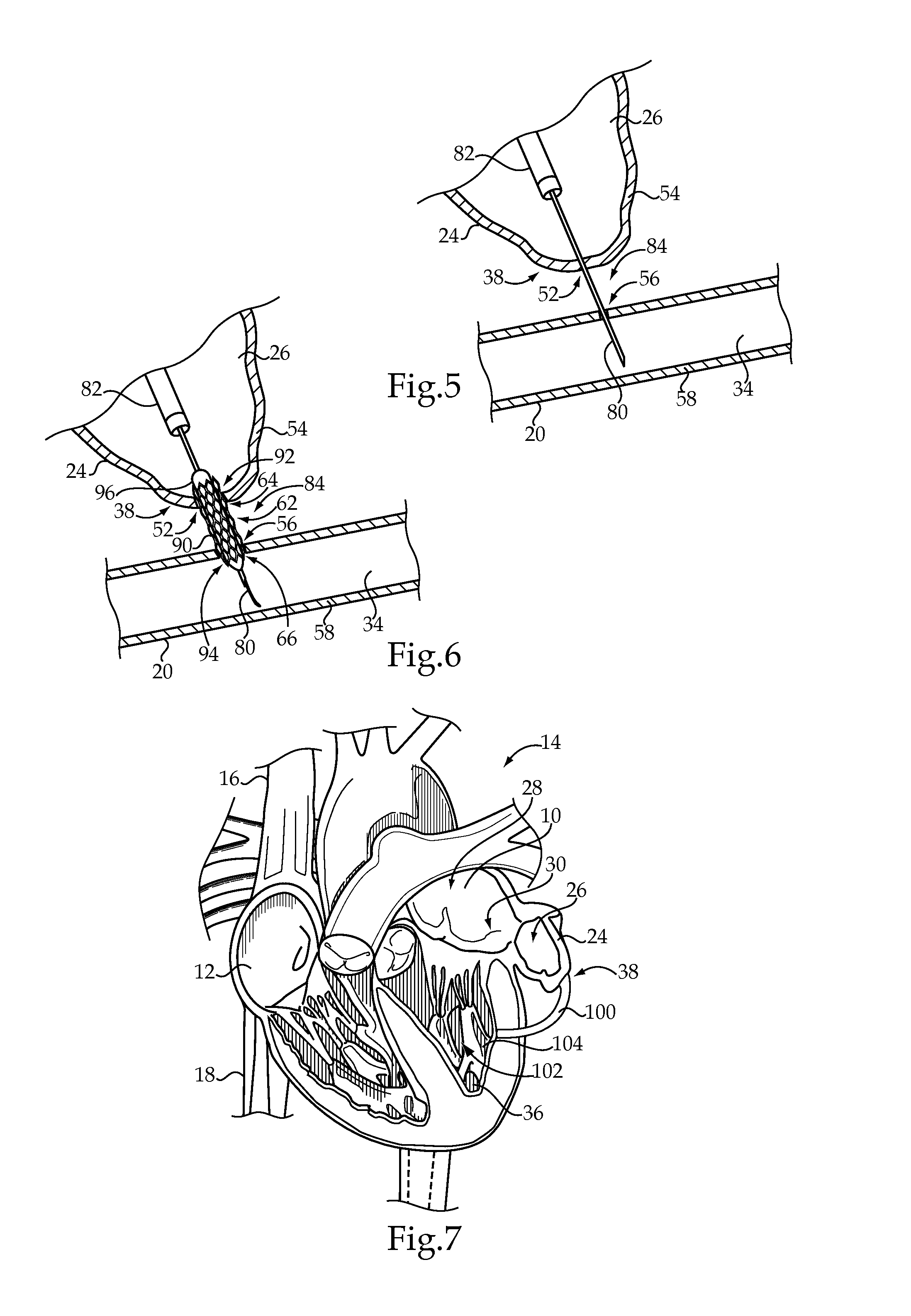 Left Atrial Appendage Shunt